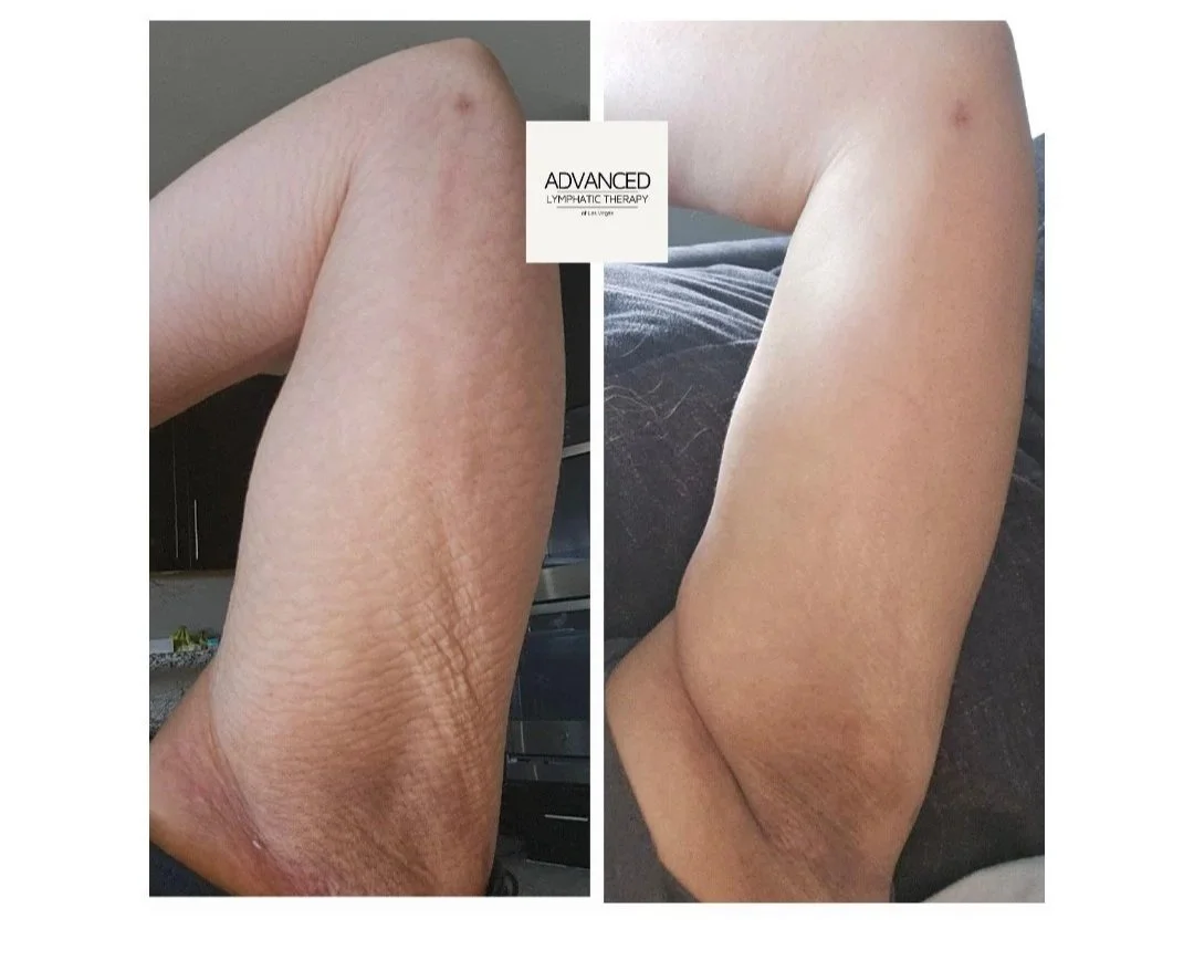 fibrosis massage after liposuction in las vegas