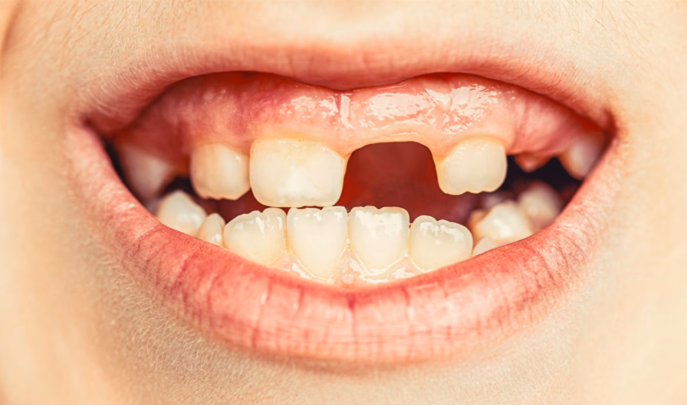 Close-up of a child's mouth showing missing and fallen-out baby teeth
