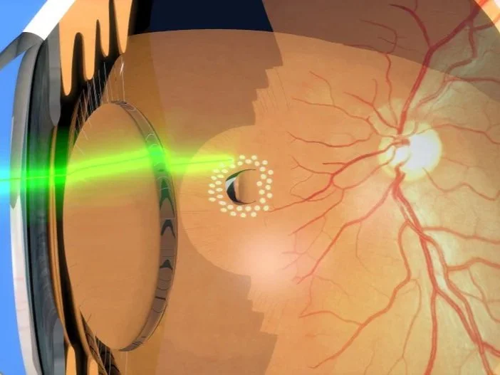 Retina Laser Simi Valley
