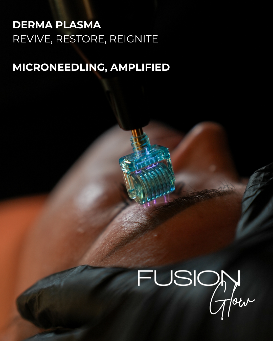 Plasma Micro-Needling Lisburn