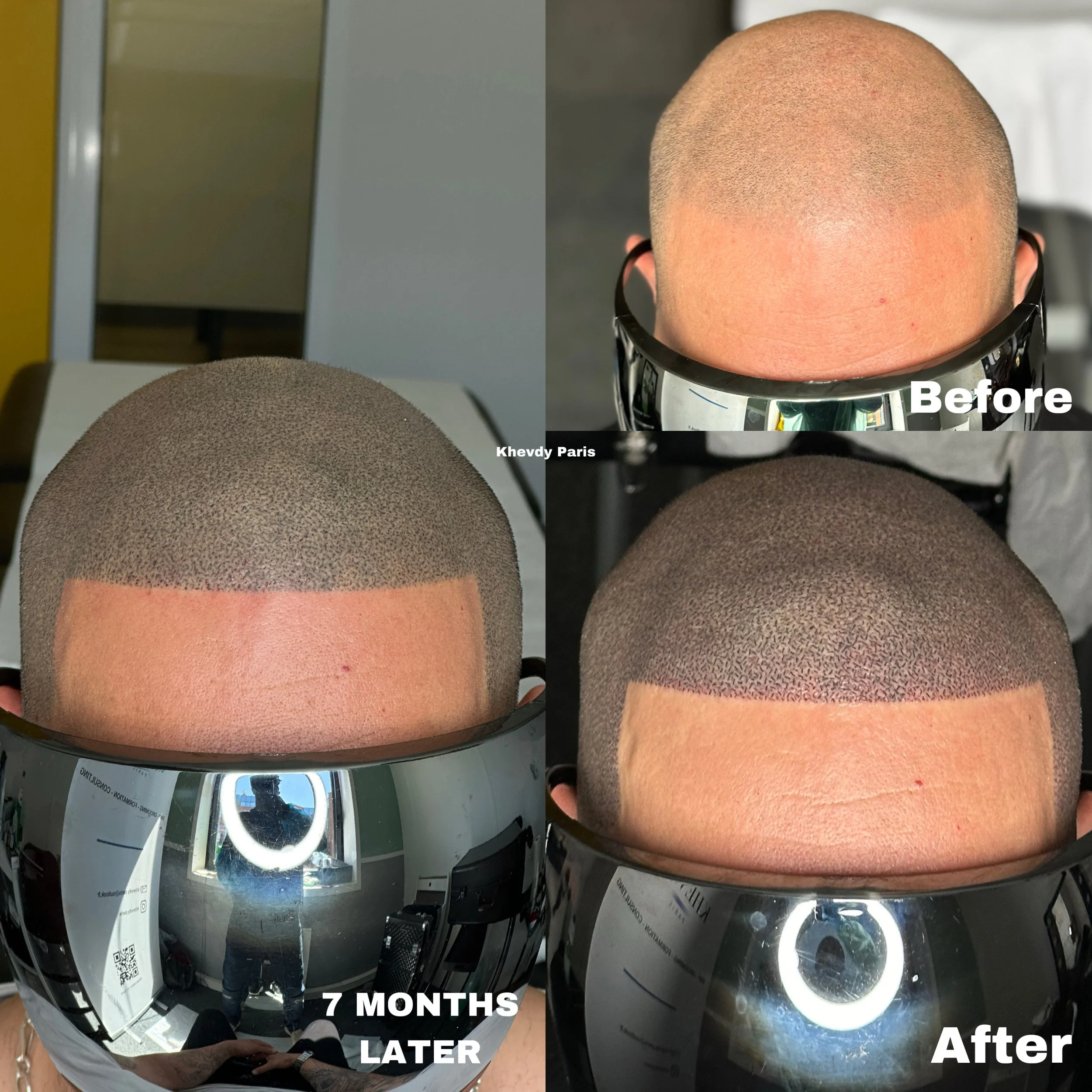 Une série de quatre photos montrant le processus de rasage de tête et de placement d'une barbe à poudre. La première image montre une tête rasée sans couleur, la deuxième montre la tête avec un rasage et des lunettes de soleil, la troisième montre un