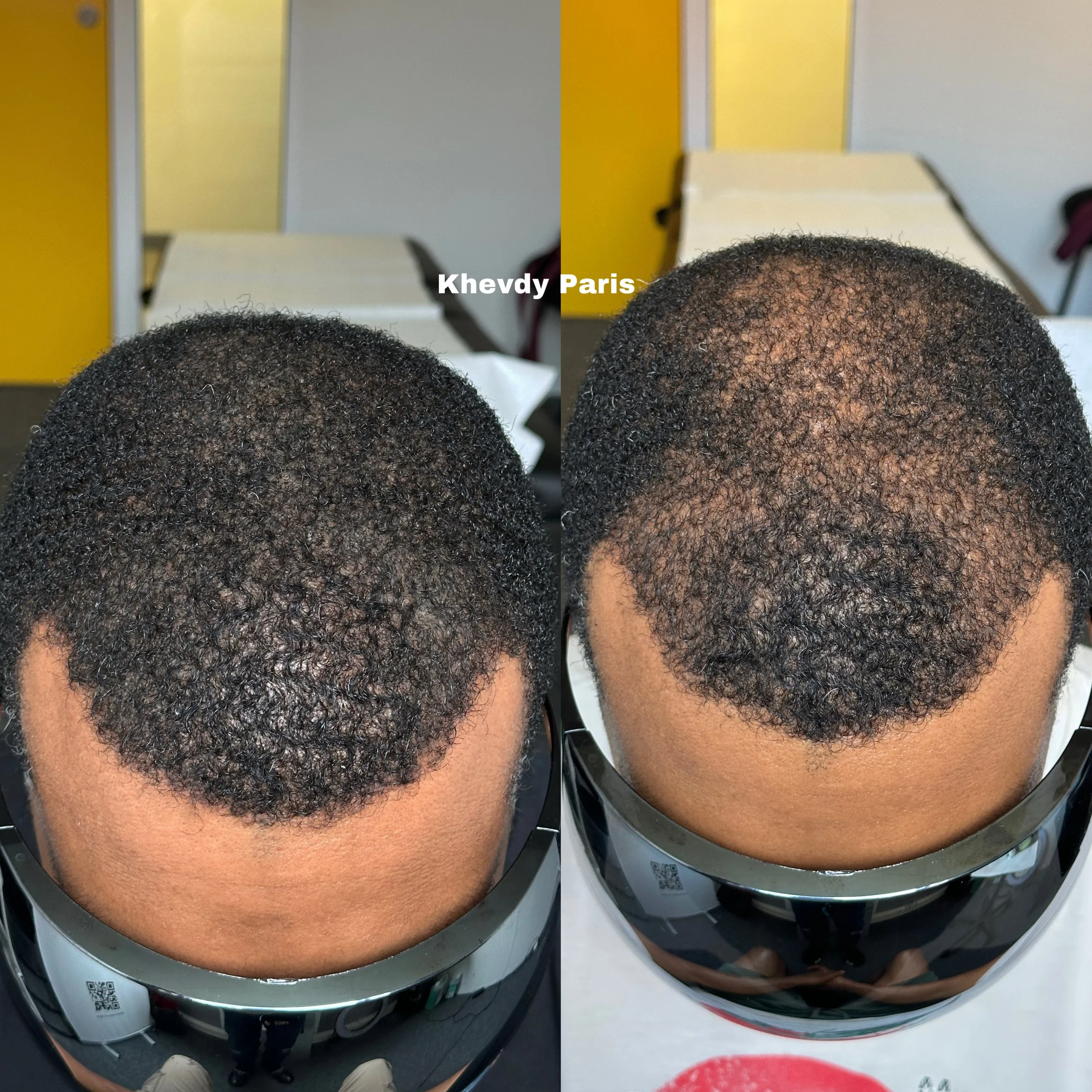  micropigmentation-capillaire-densification-homme-peau-claire.jpg micropigmentation-capillaire-densification-zone-frontale-paris.jpg