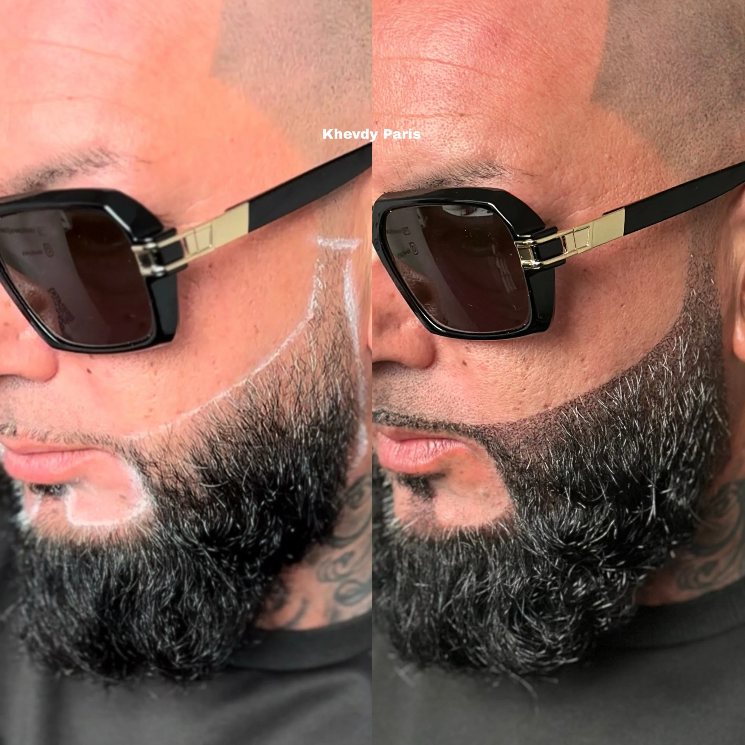 SMP Barbe : Ajoutez de la densité à votre barbe ou comblez les zones clairsemées, avec ou sans greffe préalable. Notre approche sur mesure garantit un rendu naturel, qu’il s’agisse de contours définis ou d’une densité subtile et harmonieuse.