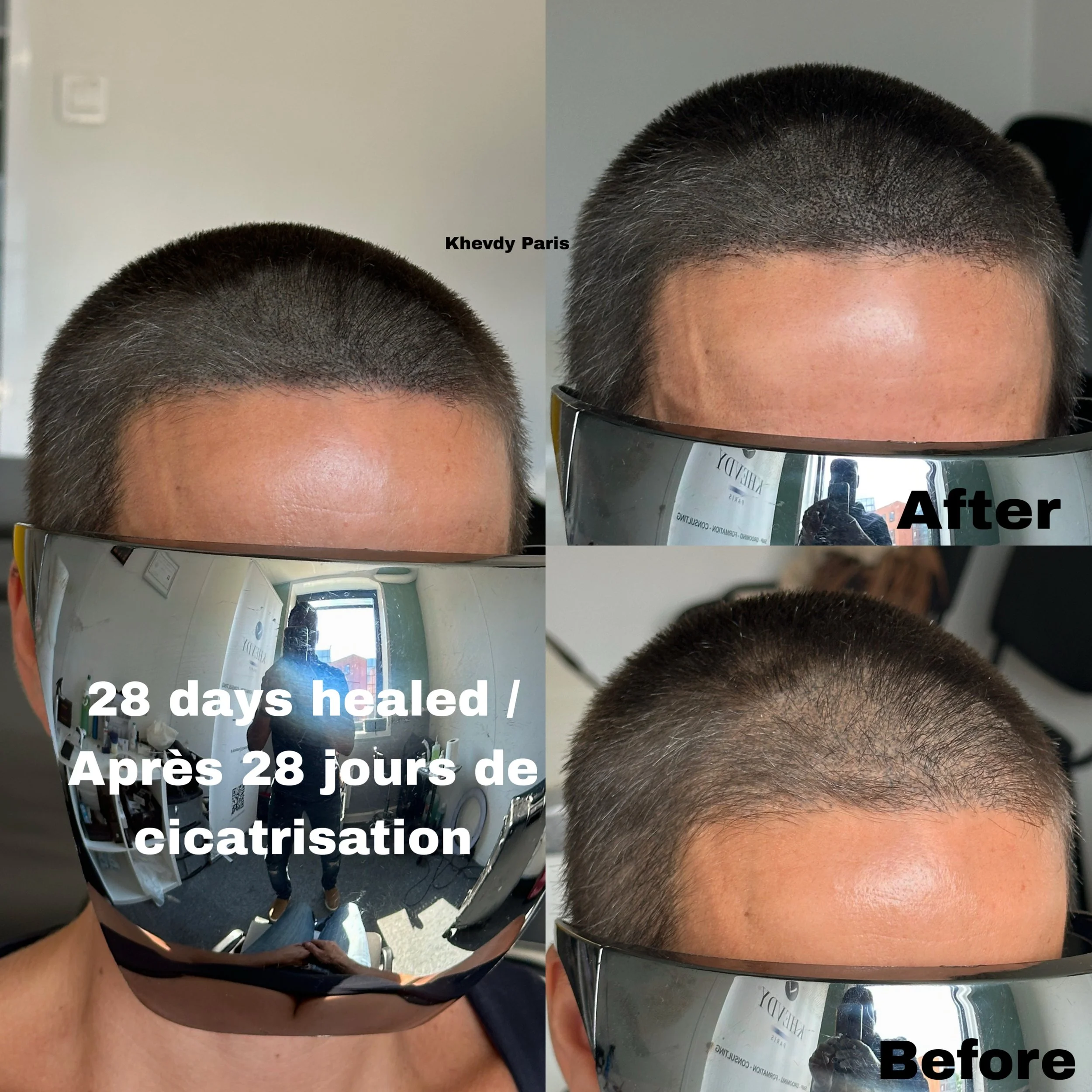 Photo montrant la transformation capillaire d'un homme avec une coupe courte, comparant l'avant et l'après 28 jours de cicatrisation, avec une légende en français et en anglais.