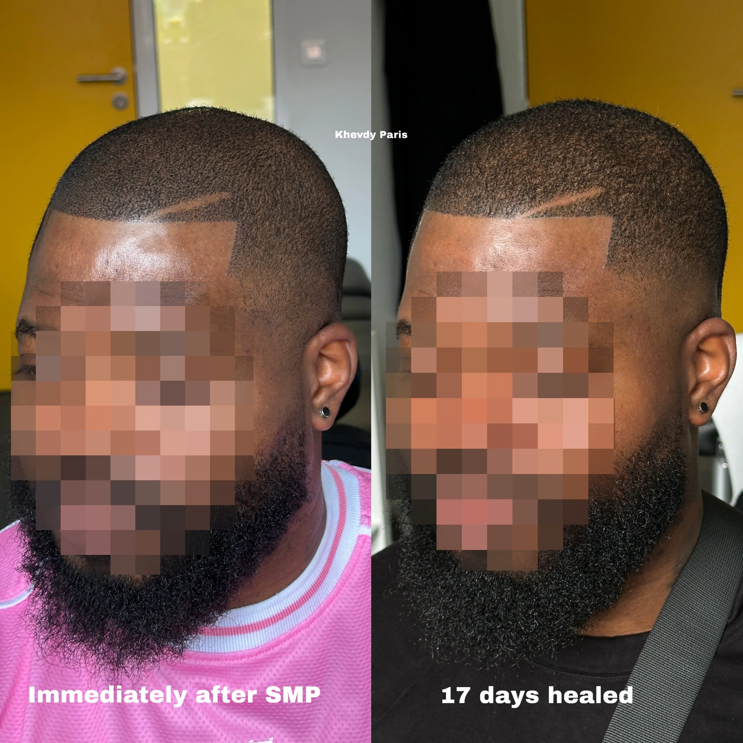 Photo comparative montrant un homme avant et après traitement de soins de la peau, avec une coiffure courte et une barbe épaisse. La gauche indique 'Immédiatement après SMP', la droite '17 jours guéris'.