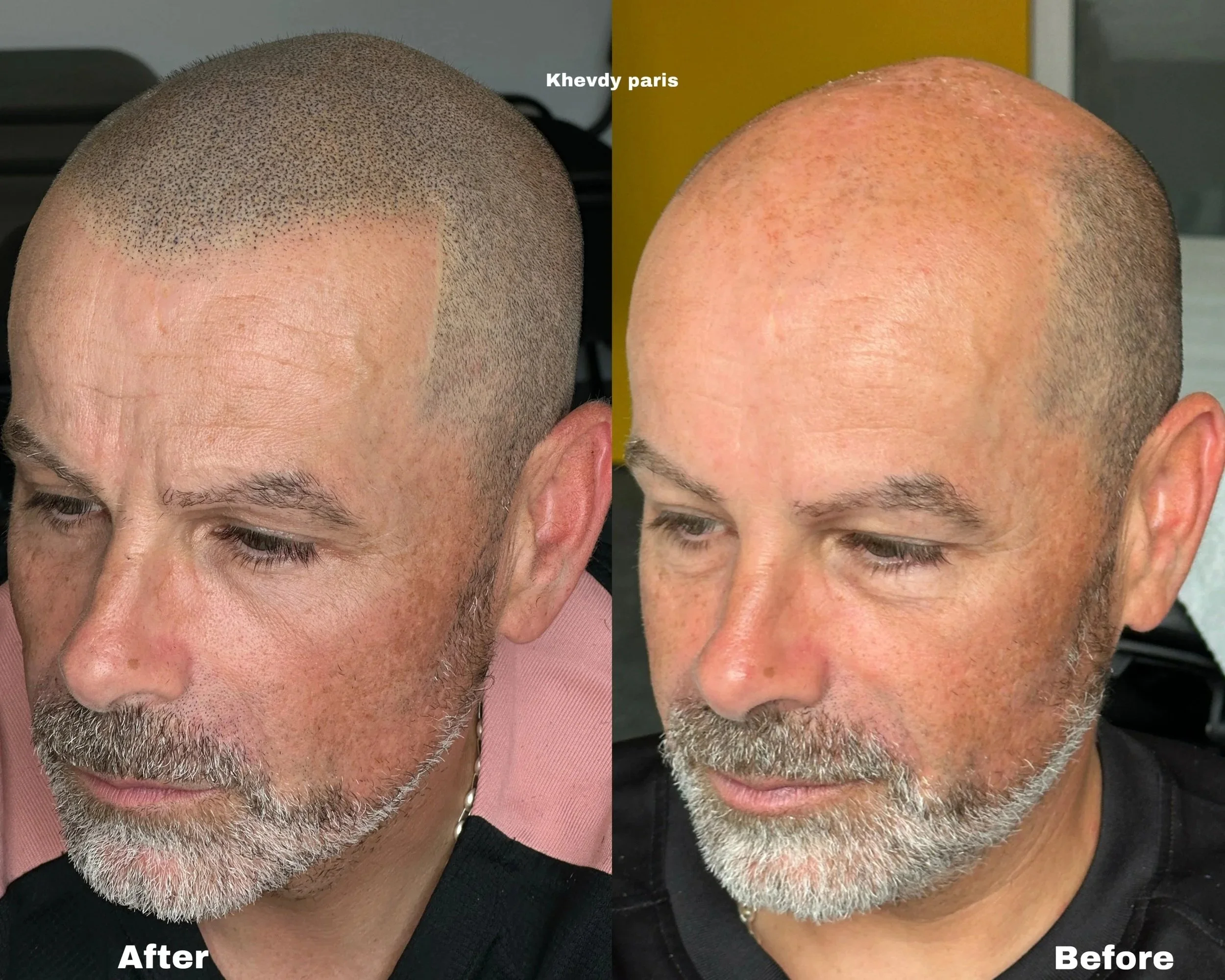 Avant/Après micropigmentation capillaire contre la calvitie