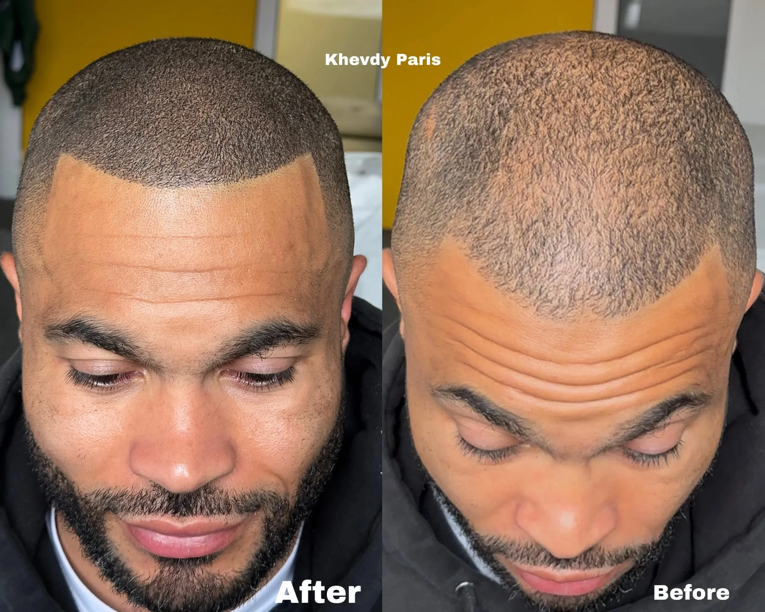 Avant/Après micropigmentation capillaire pour ajouter de la densité