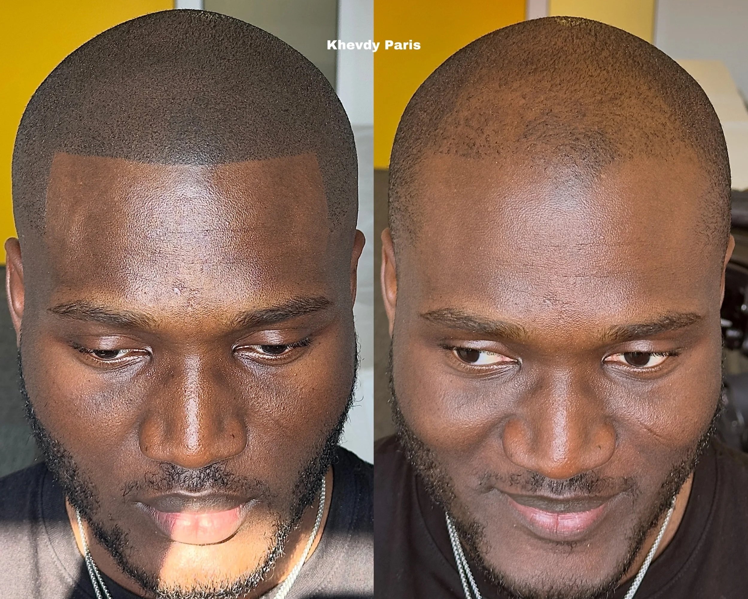 Avant/Après micropigmentation capillaire, effet rasé style américain