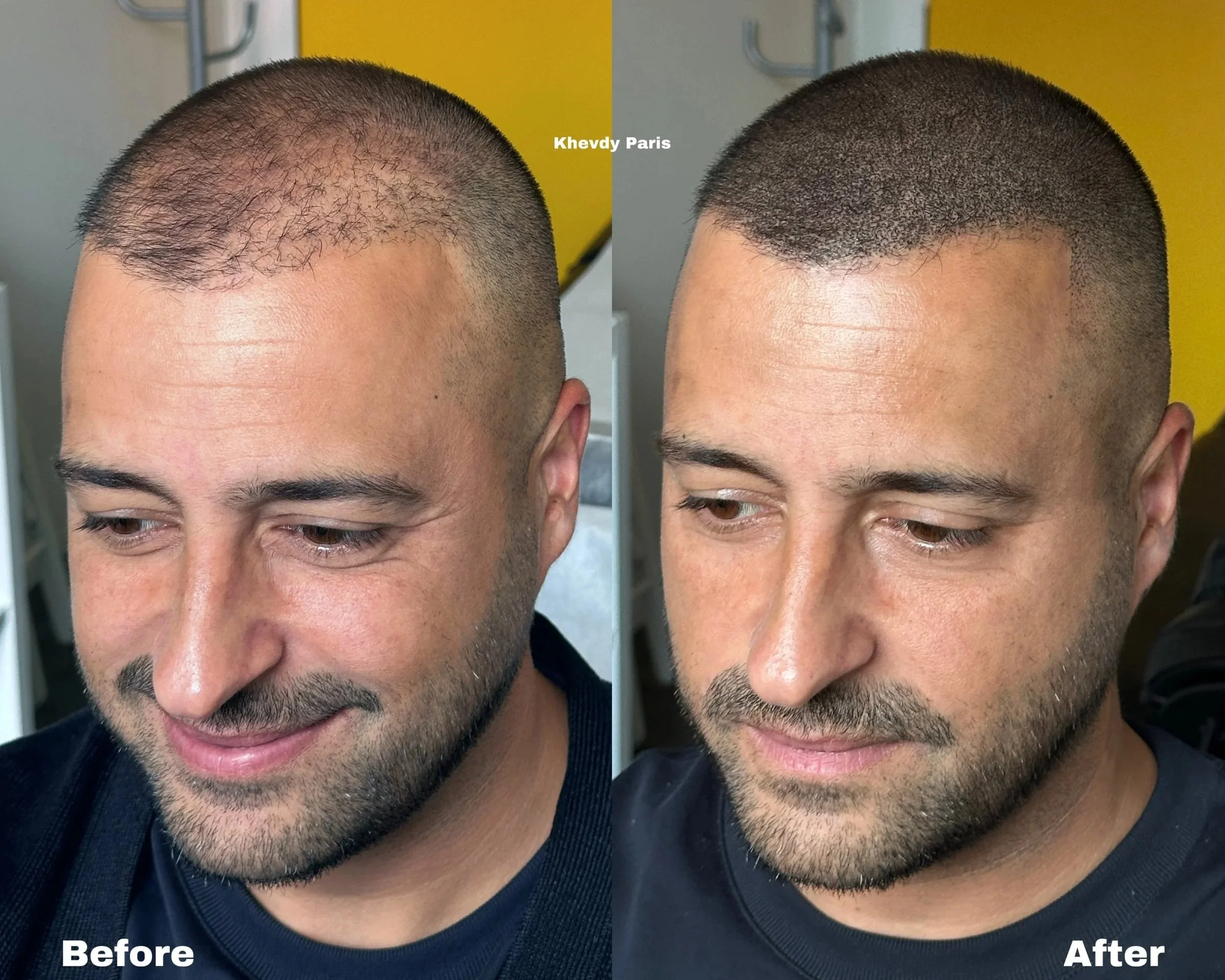 Avant/Après Micropigmentation capillaire pour compléter la greffe  