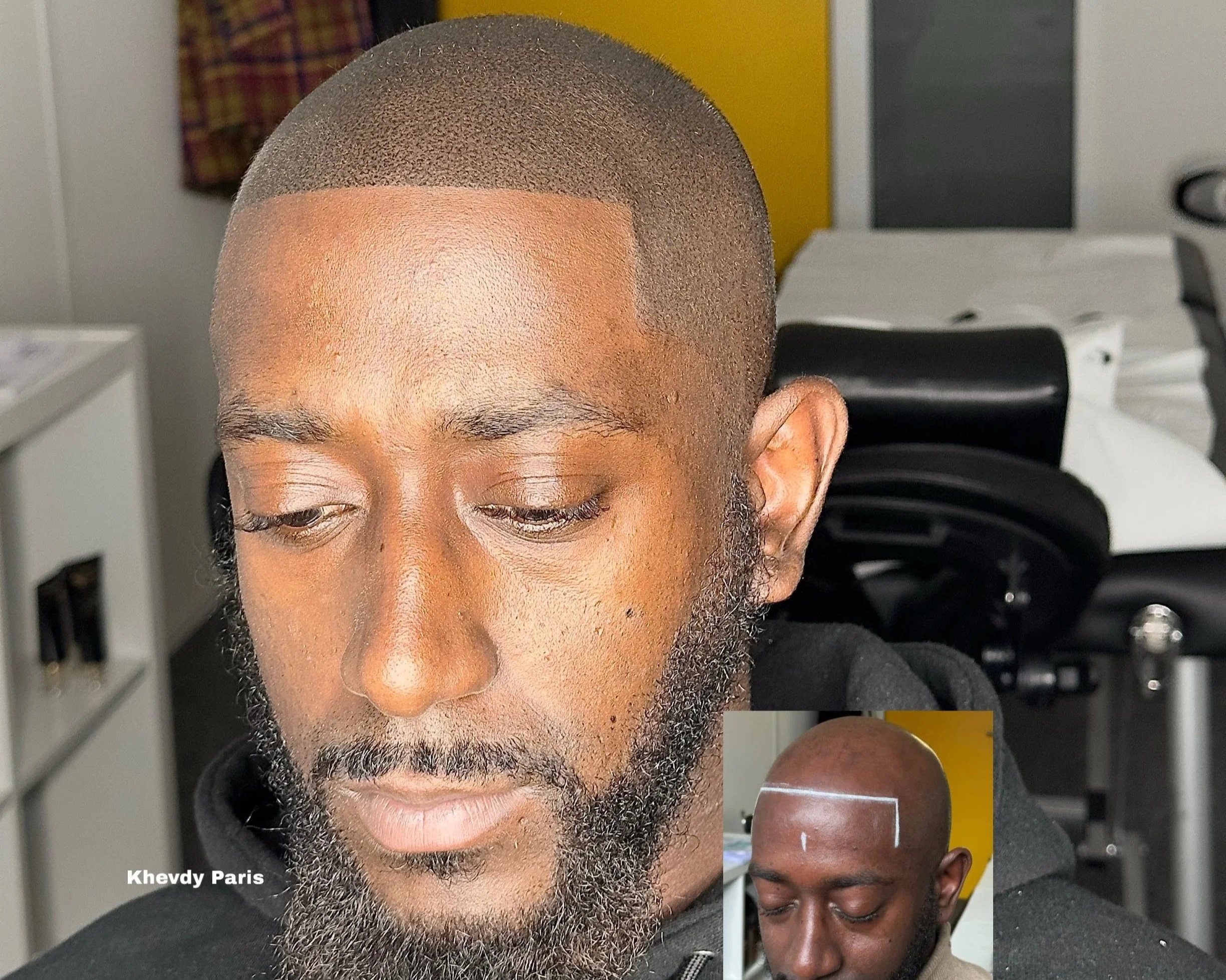 Effet rasé style américain.  Retrouvez un look homogène et naturel, efficace contre la calvitie à tous les stades. Quel que soit le niveau d’évolution, notre approche sur mesure garantit un résultat optimal, avec un suivi personnalisé sur plusieurs m