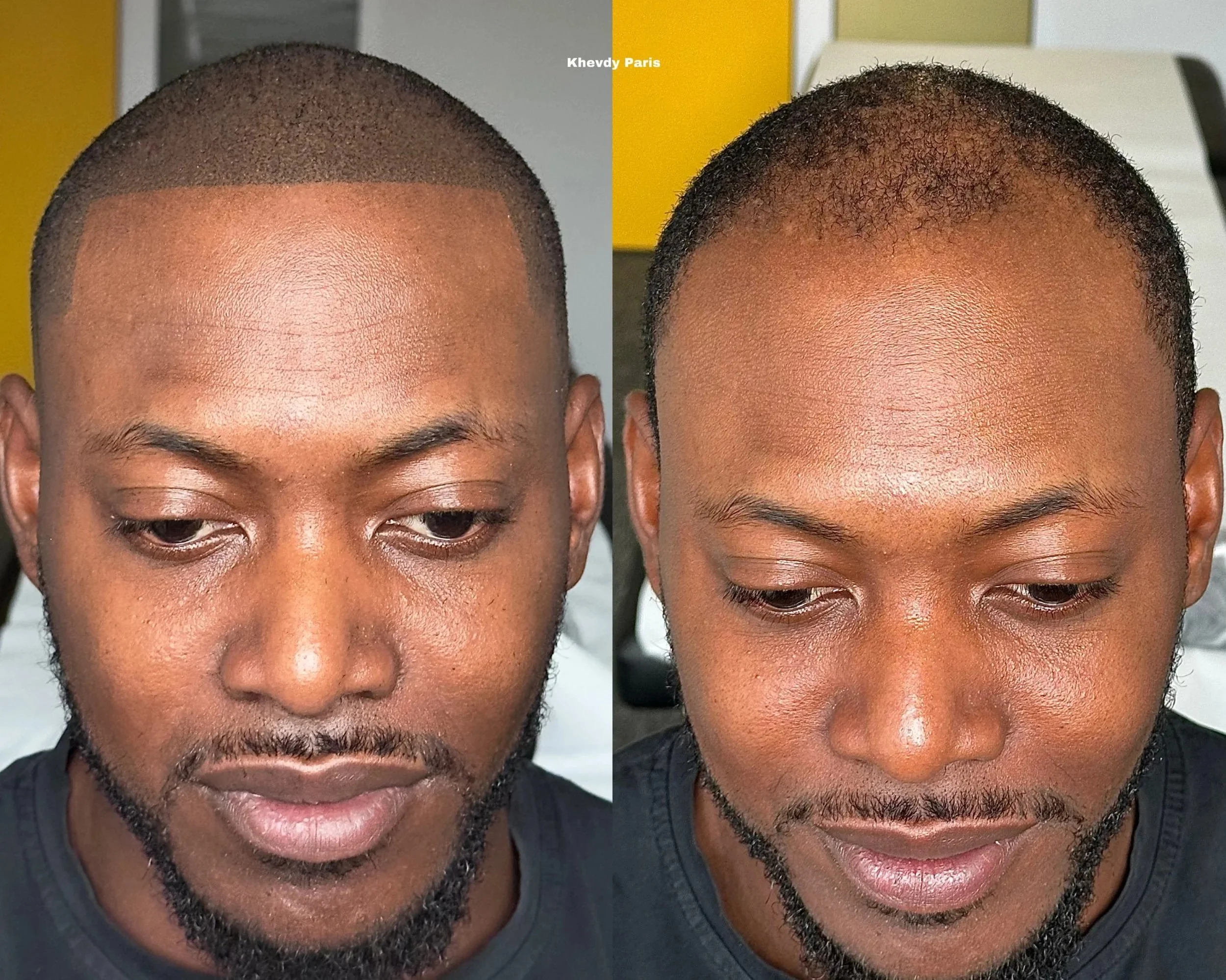 Avant/Après micropigmentation pour restaurer les contours et densifier