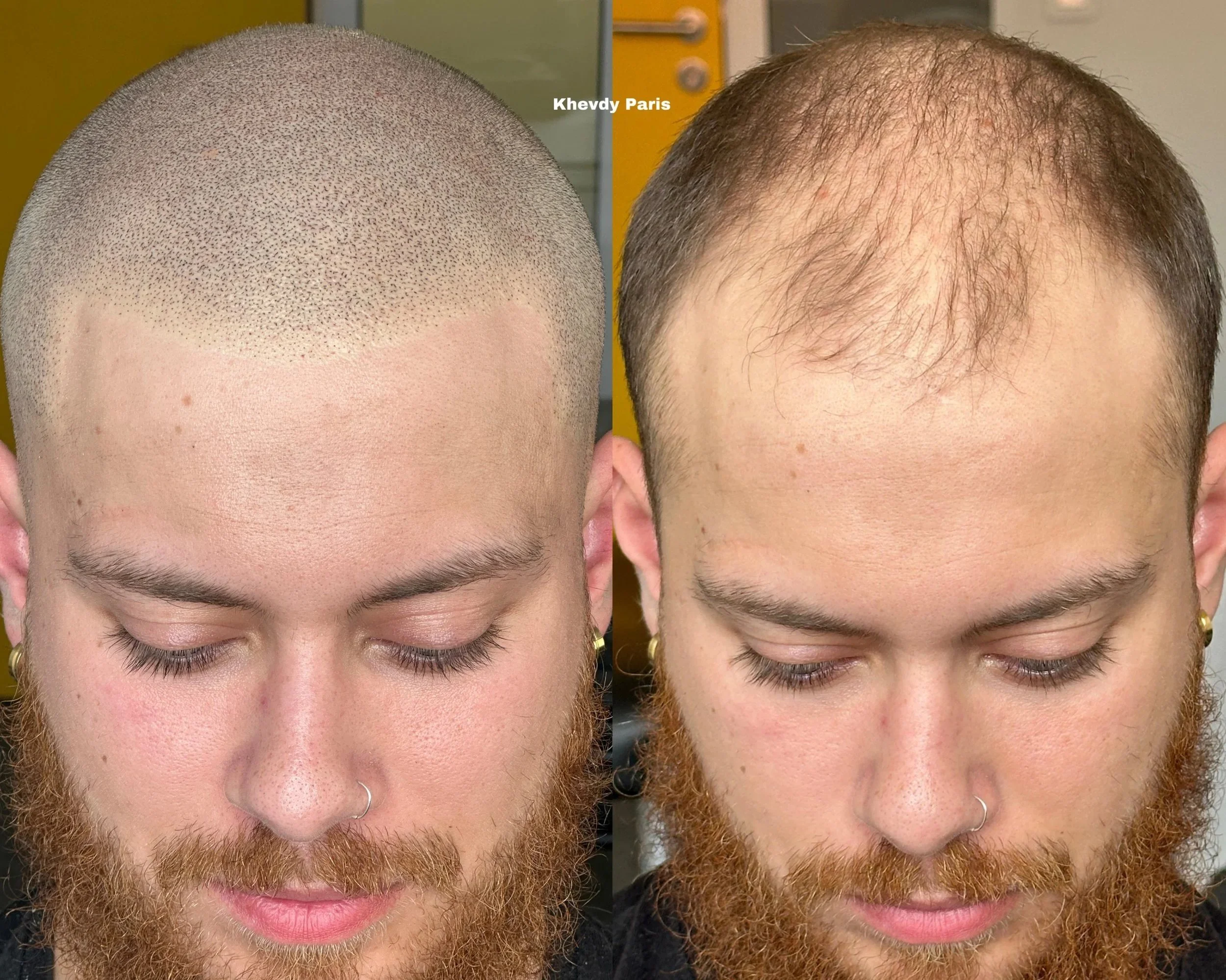 Avant/Après Micropigmentation capillaire, effet rasé style européen
