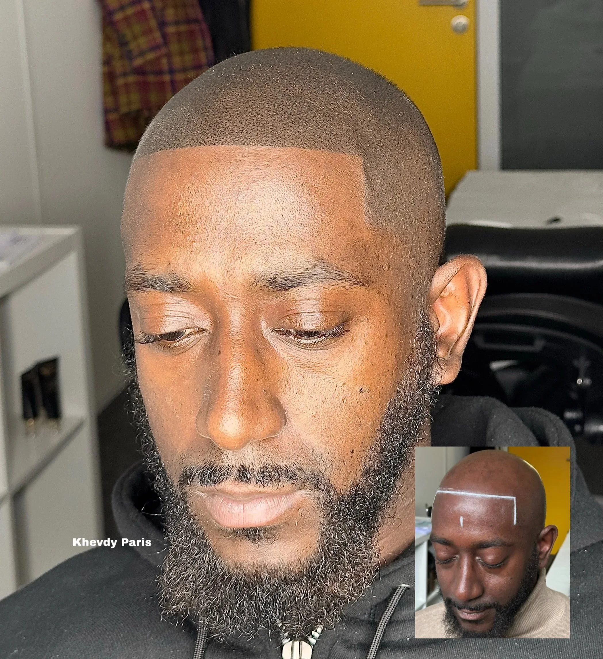 Un homme dont la tête a été rasée de près, montrant un travail de coupe de cheveux détaillé. La version plus petite en bas à droite montre la tête de la même personne avant la coupe, avec un dessin en ligne blanche sur le cuir chevelu indiquant la no