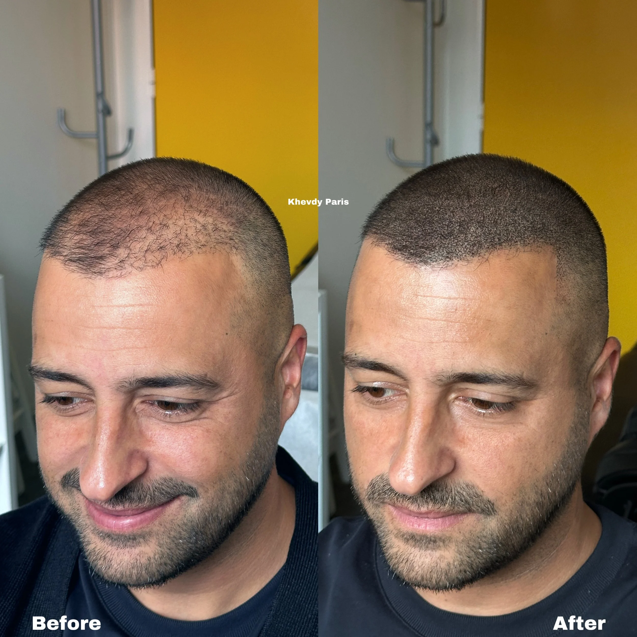 Micropigmentation capillaire vs greffe capillaire : quelle solution choisir ?