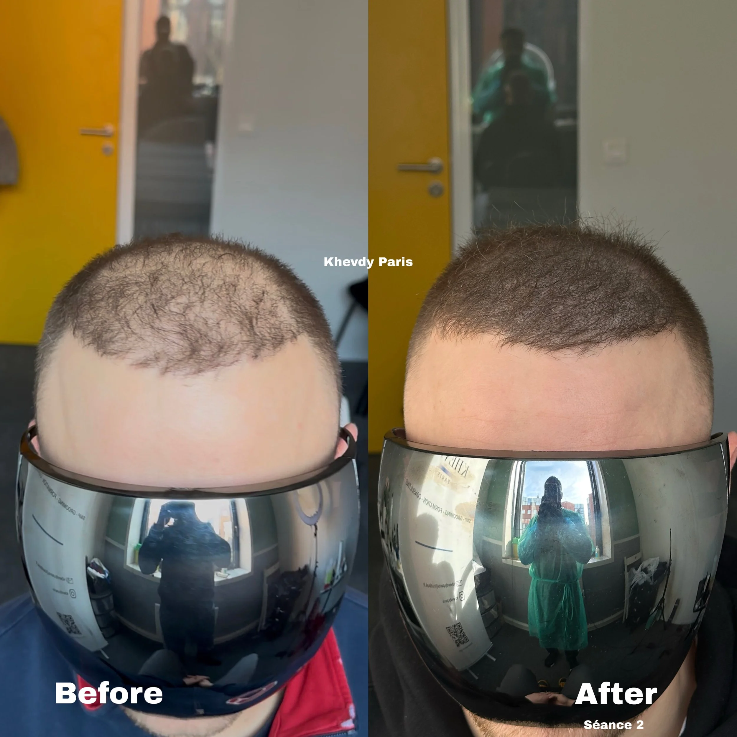 Peut-on faire une micropigmentation avant ou après une greffe de cheveux ?