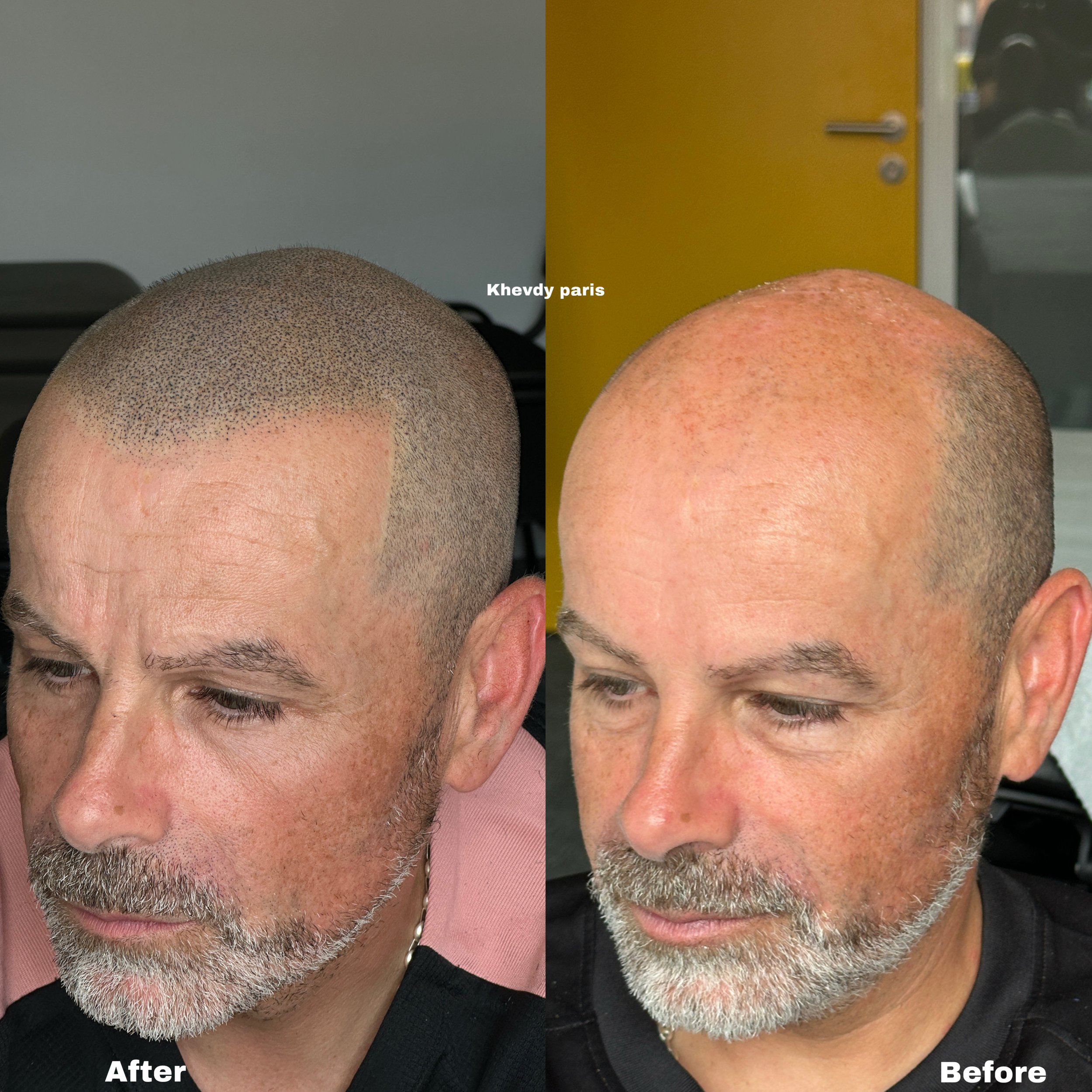 SMP vs tricopigmentation : quelles différences et quelle solution choisir ?