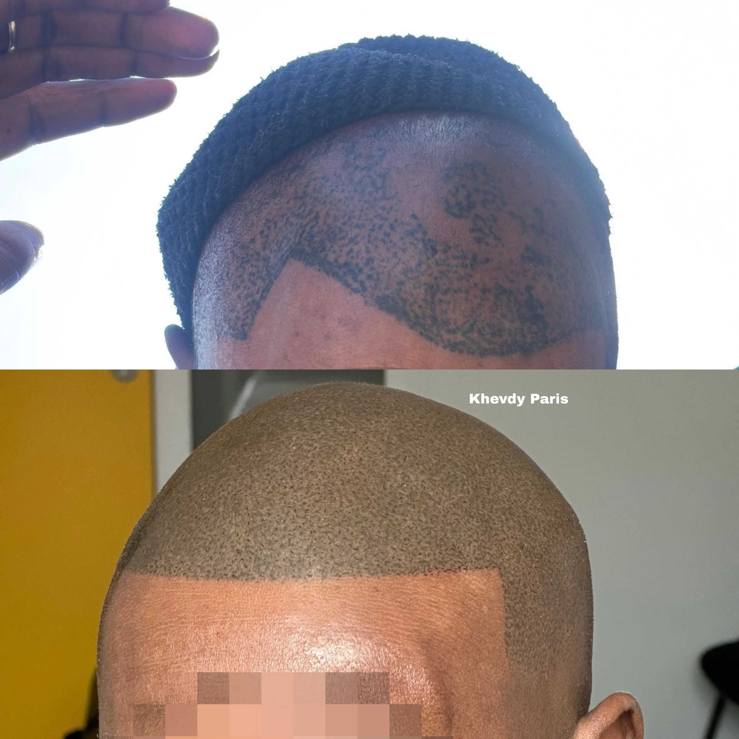 Quelle est la différence entre le tatouage et la micropigmentation capillaire (SMP) ?