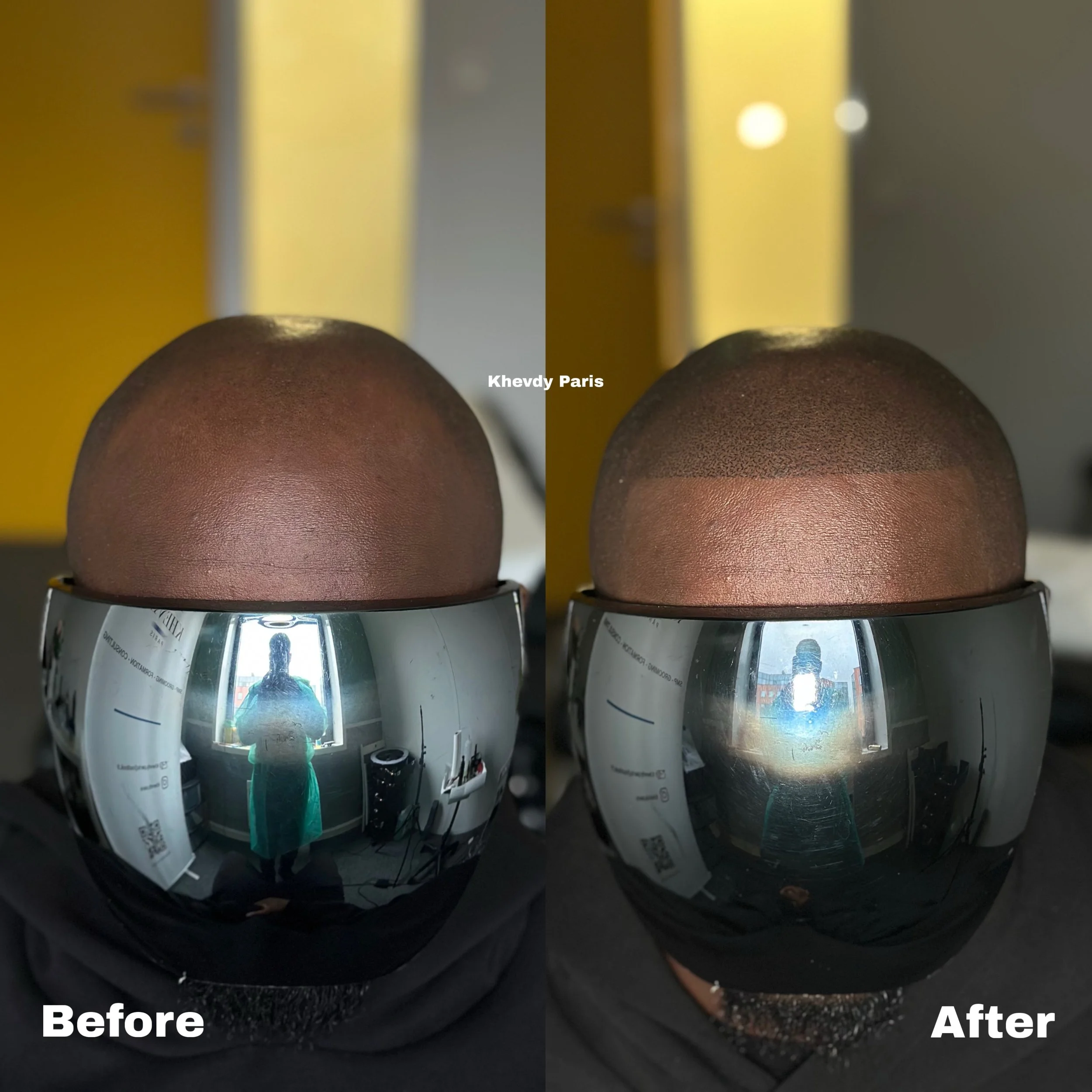 AS Monaco 🇲🇨 ⚽️ pro soccer player to Khevdy Paris 🇫🇷🌎. Before/After SMP micropigmentation. Pr&eacute;cision &amp; Excellence 

Un immense merci &agrave; notre Client pour sa confiance et sa patience. Malgr&eacute; un emploi du temps extr&ecirc;m