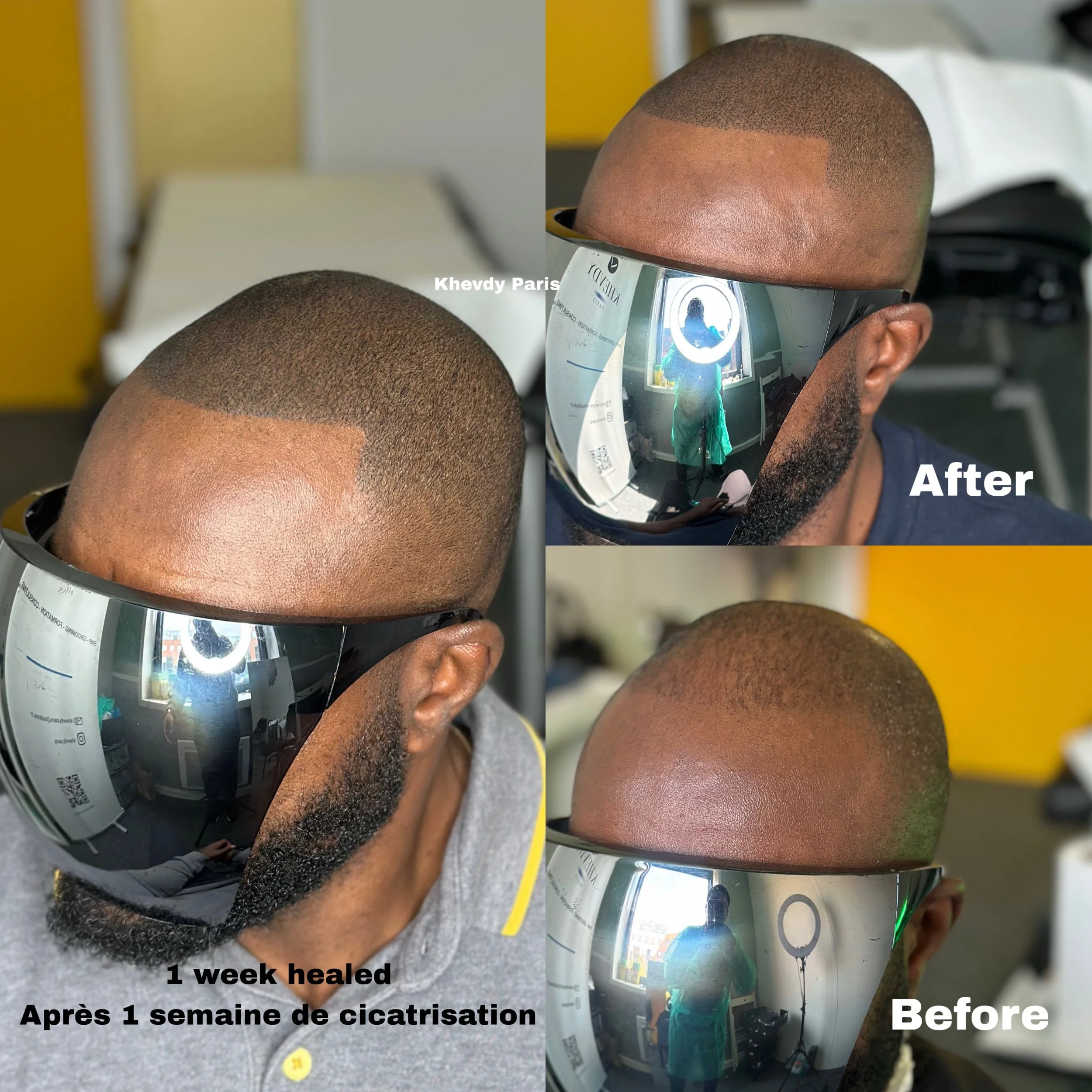 From C&ocirc;te d&rsquo;Ivoire 🇨🇮 to Khevdy Paris🇫🇷🌎 1 week healed. Les r&eacute;sultats apr&egrave;s 1 semaine de cicatrisation dans le cadre du suivi personnalis&eacute;. 

Depuis longtemps, il r&ecirc;vait de concr&eacute;tiser ce projet. Ini