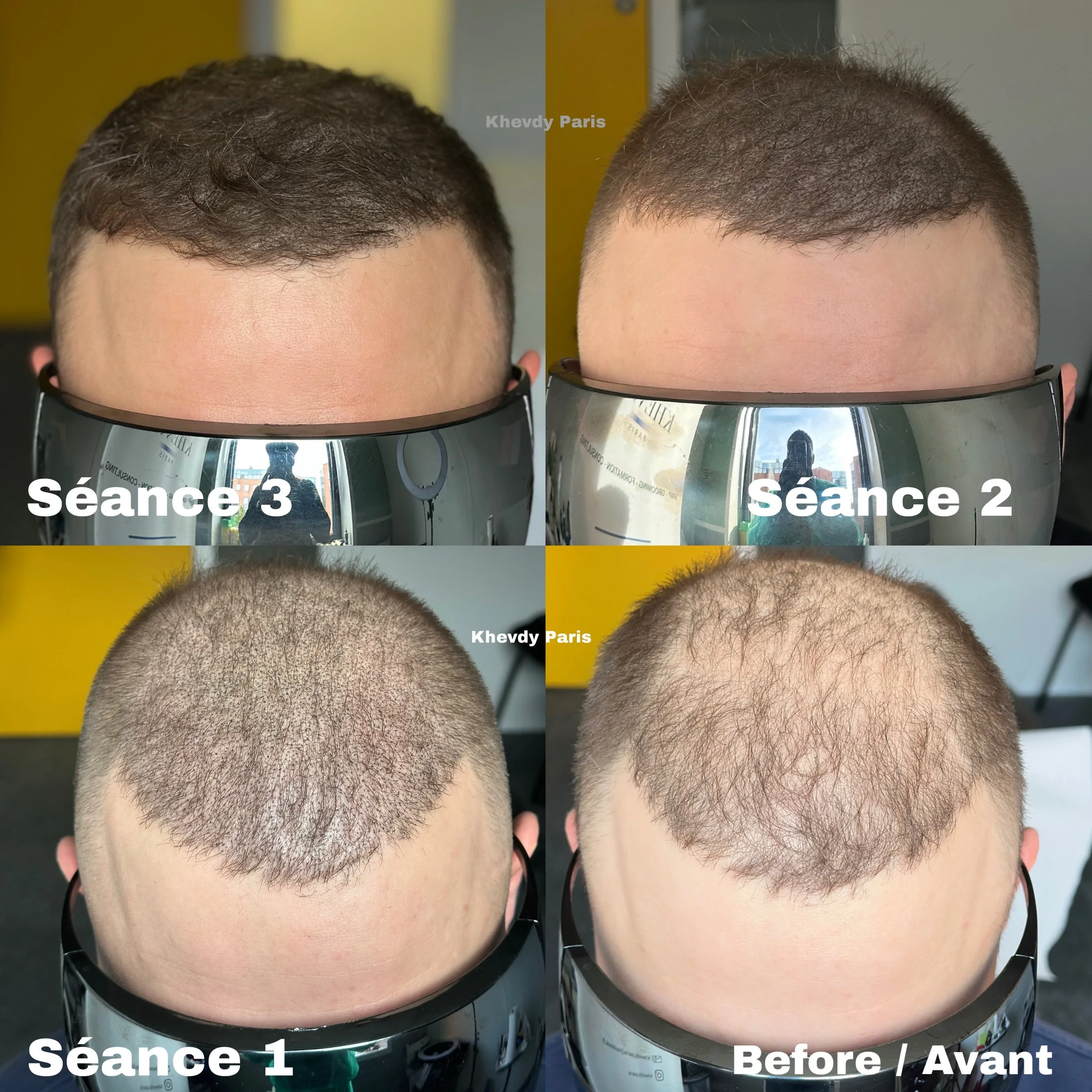 SMP DENSIT&Eacute; S&Eacute;ANCE 3/3 ✅ SMP DENSITY 3rd session CLIENT FROM LILLE TO @khevdyparis 🇫🇷🌎 TRAVAIL PERSONNALIS&Eacute; POUR COMPL&Eacute;TER LA GREFFE

- r&eacute;sultats &eacute;volutifs et naturels ✅
- travail personnalis&eacute; pour 