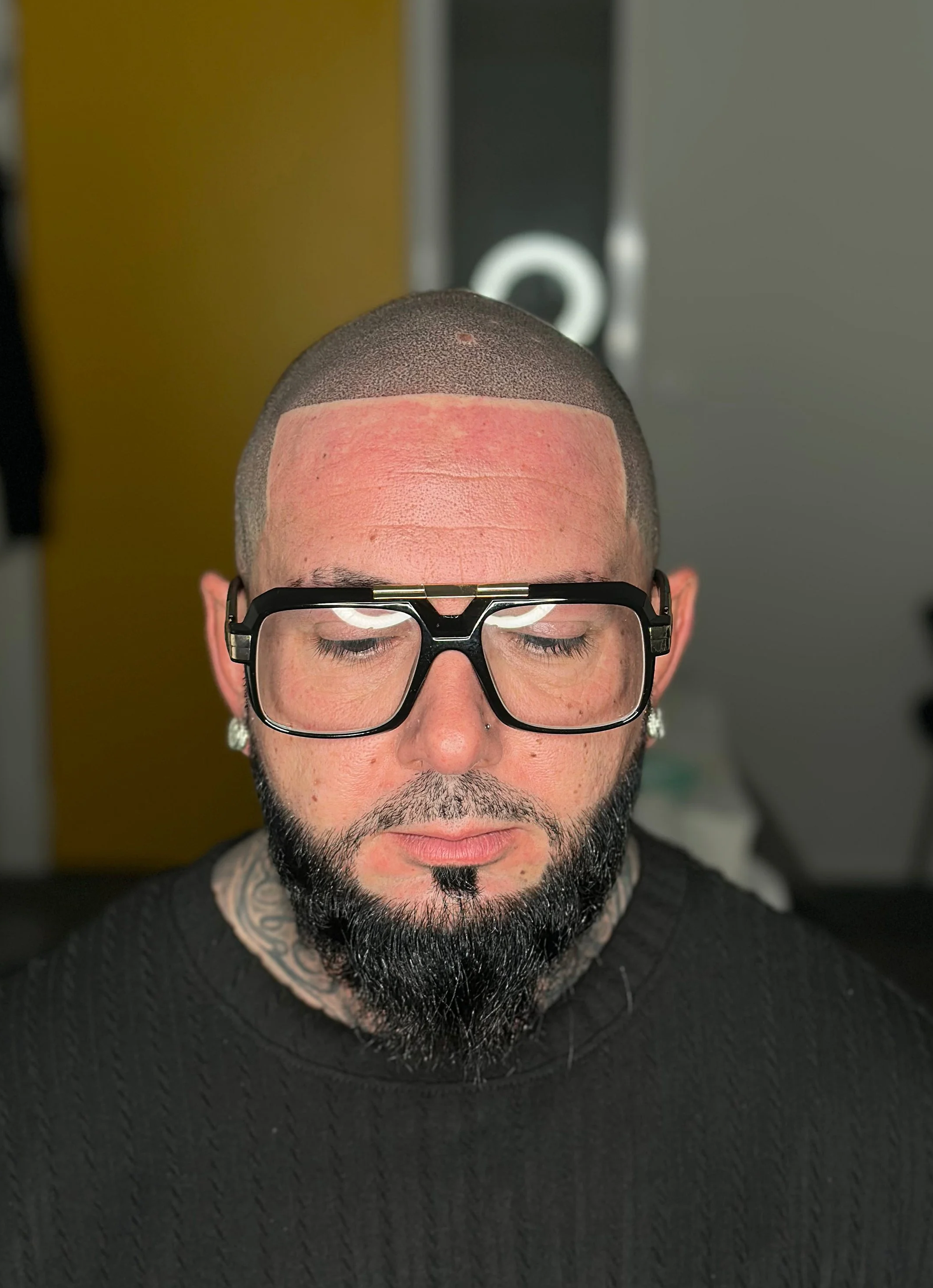 Micropigmentation capillaire réalisée pour une calvitie, résultat naturel et discret.