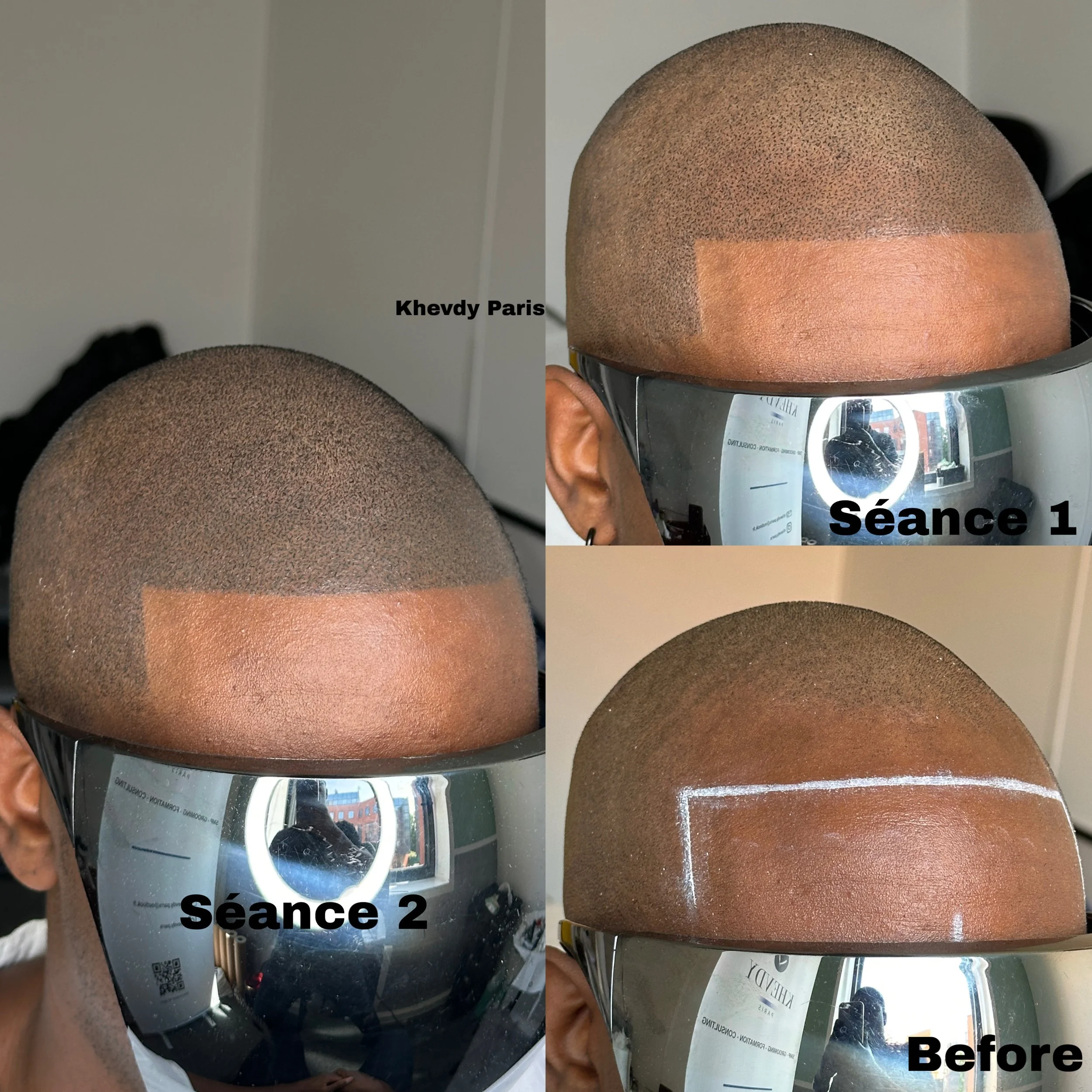 Progression de la coupe de cheveux d'un homme, montrant une transformation avant (photo en bas à droite), la première séance (top droite), et la deuxième séance (en bas à gauche), avec une coupe courte et rasée sur les côtés et une ligne précise sur 