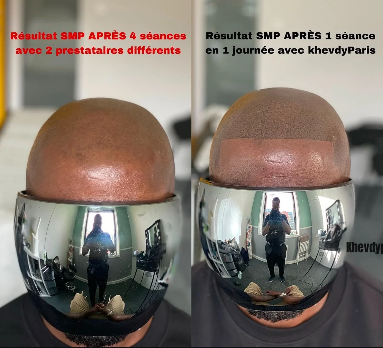 Comparaison d'un résultat de traitement capillaire. À gauche, après 4 séances avec deux prestataires différents, à droite, après une séance en une journée avec khevdyParis, montrant un cuir chevelu avant et après le traitement.