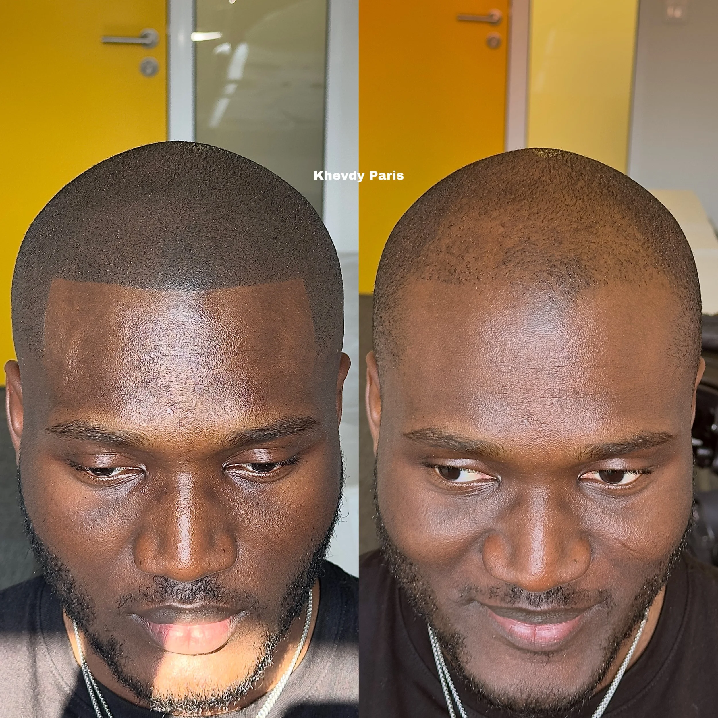 Effet rasé style américain.  Retrouvez un look homogène et naturel, efficace contre la calvitie à tous les stades. Quel que soit le niveau d’évolution, notre approche sur mesure garantit un résultat optimal, avec un suivi personnalisé sur plusieurs m