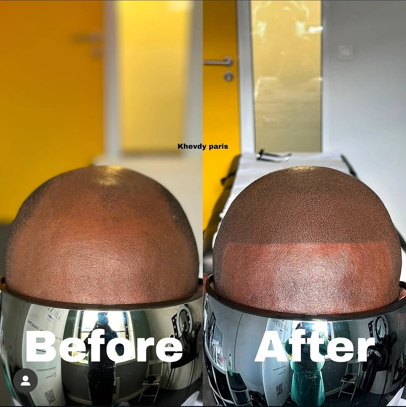 Effet rasé style américain.  Retrouvez un look homogène et naturel, efficace contre la calvitie à tous les stades. Quel que soit le niveau d’évolution, notre approche sur mesure garantit un résultat optimal, avec un suivi personnalisé sur plusieurs m