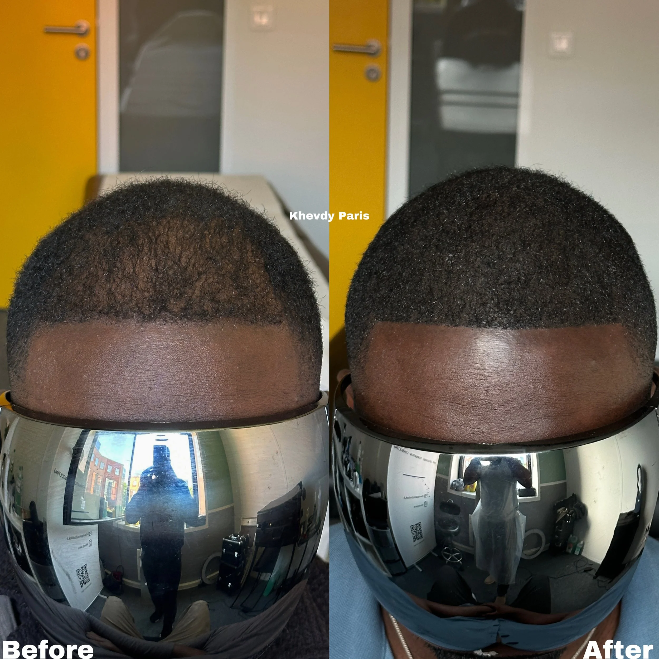 Résultat avant / après micropigmentation capillaire