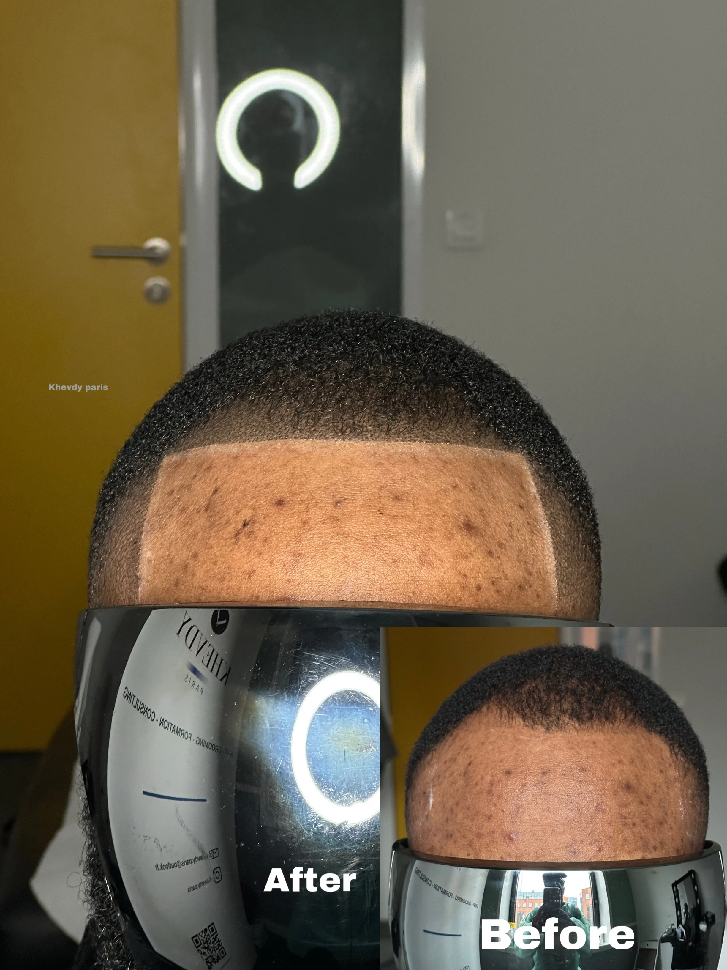 Transformation capillaire avant et après un traitement de soin capillaire, montrant une réduction des imperfections et un cuir chevelu plus uniforme.