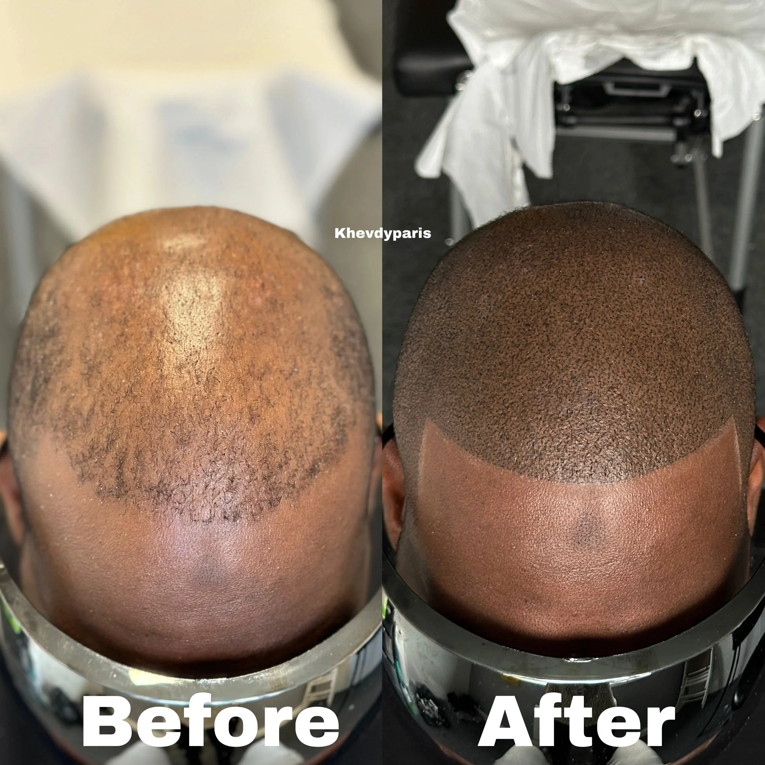 micropigmentation-capillaire-peau-foncee.jpg micropigmentation-capillaire-peau-mate.jpg micropigmentation-capillaire-peau-claire.jpg