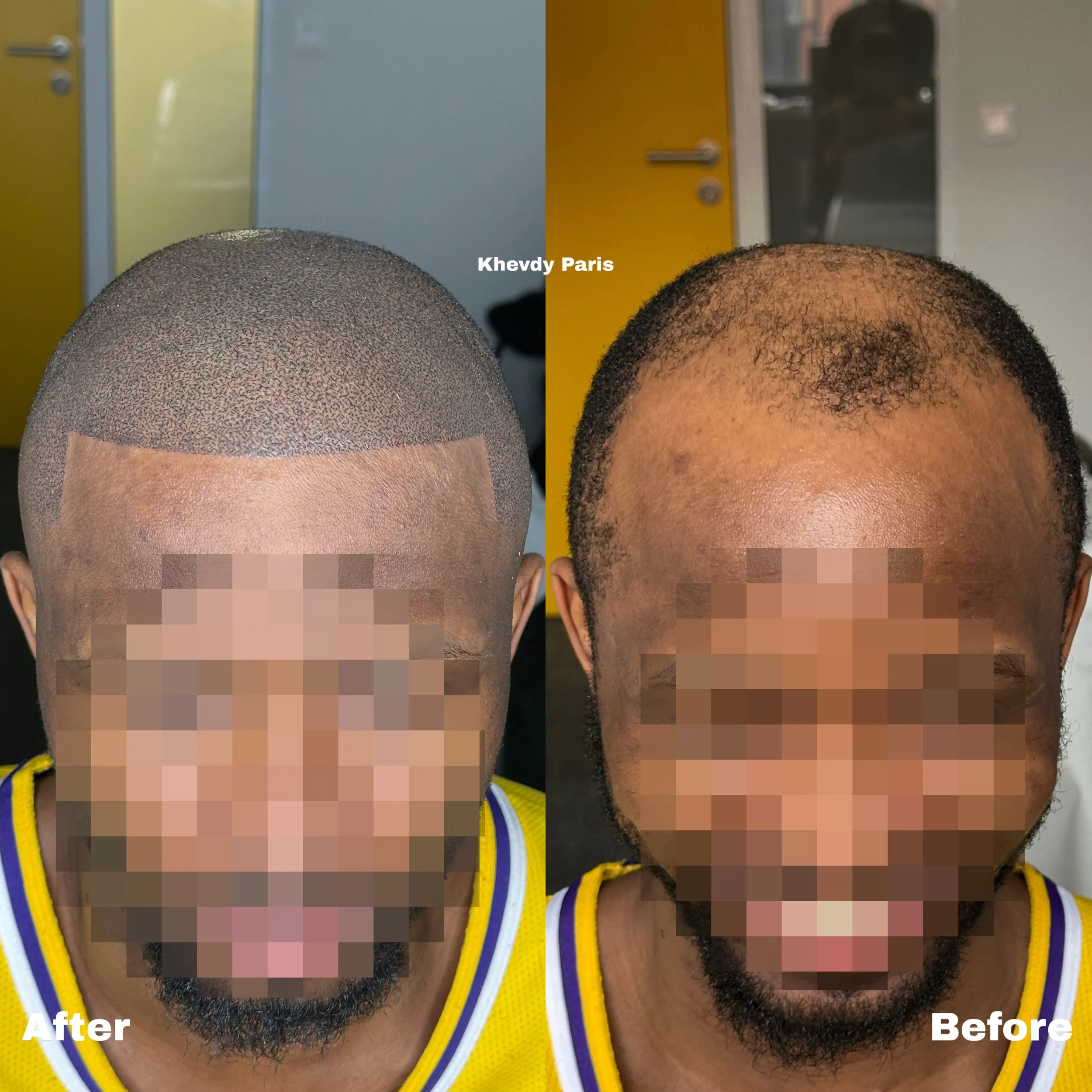 Comparison of a man before and after scalp micropigmentation treatment, showing a full head of short, simulated hair on the left and thinning hair on the right, both with pixelated faces for anonymity.