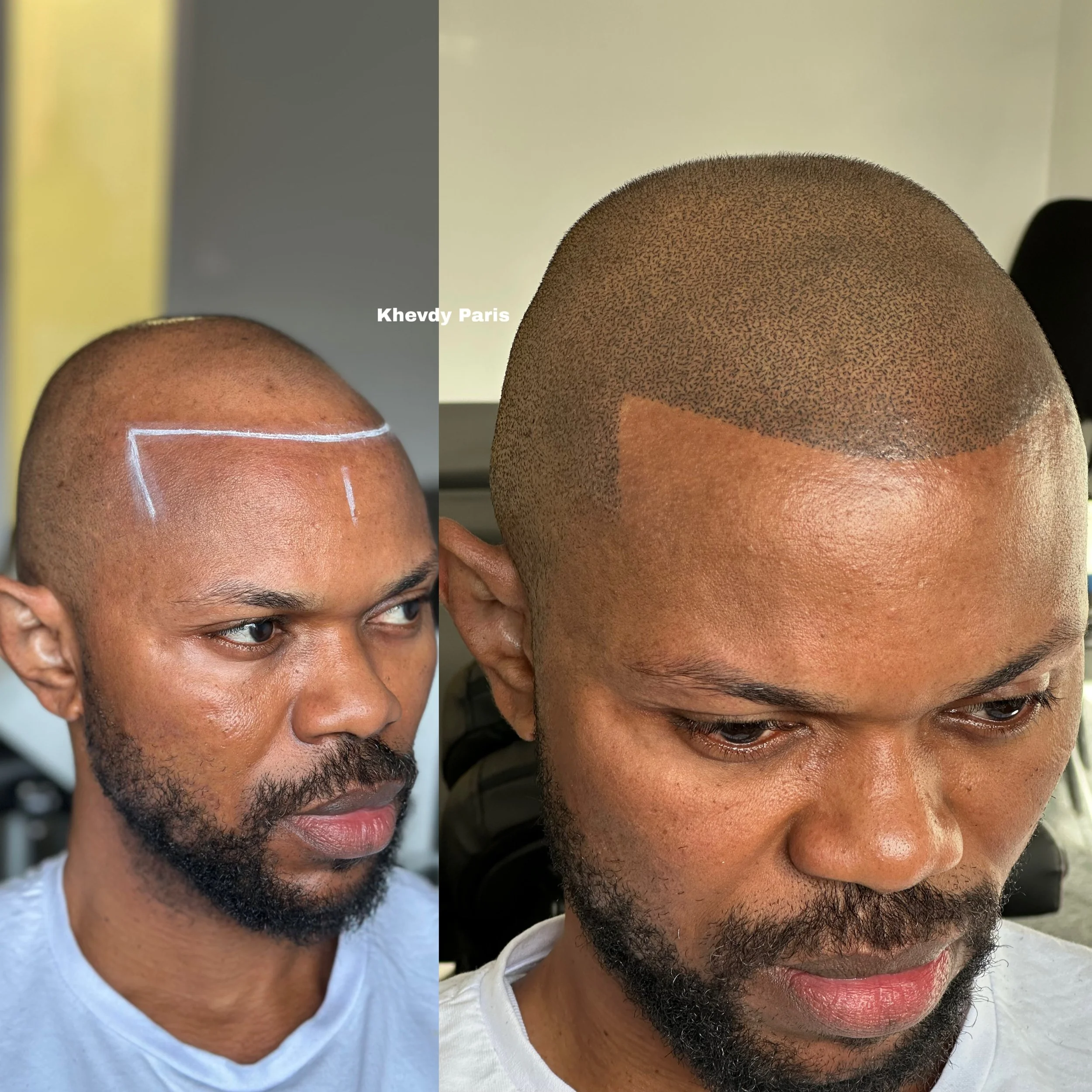 Deux photos côte à côte d'un homme à la tête rasée, montrant avant et après une coupe de cheveux. La première image montre des marques de crayon sur le cuir chevelu, la seconde montre une tête rasée et tonifiée.