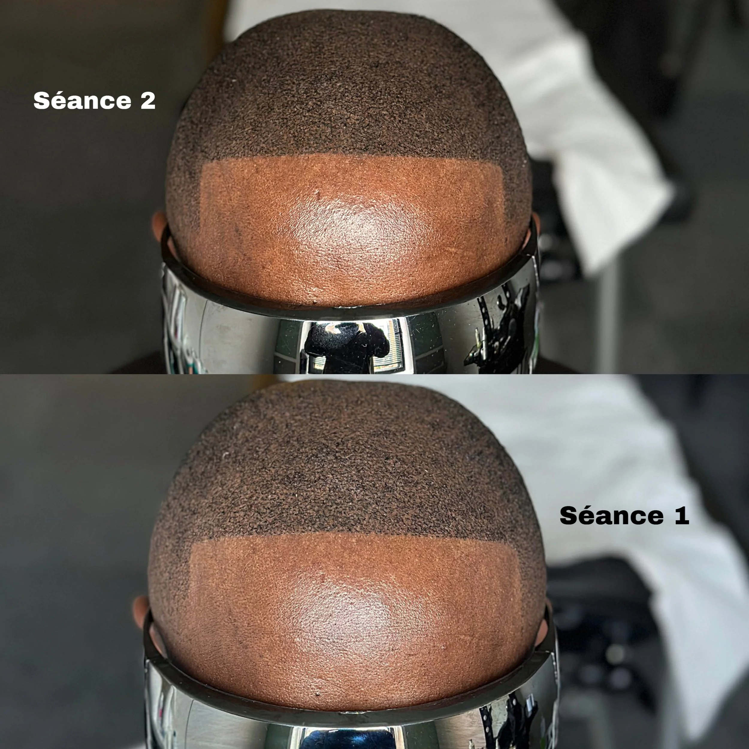 SMP après l'échec de la greffe pour satisfaire le besoin de notre qui souhaitait des résultats efficaces et fiables ! 