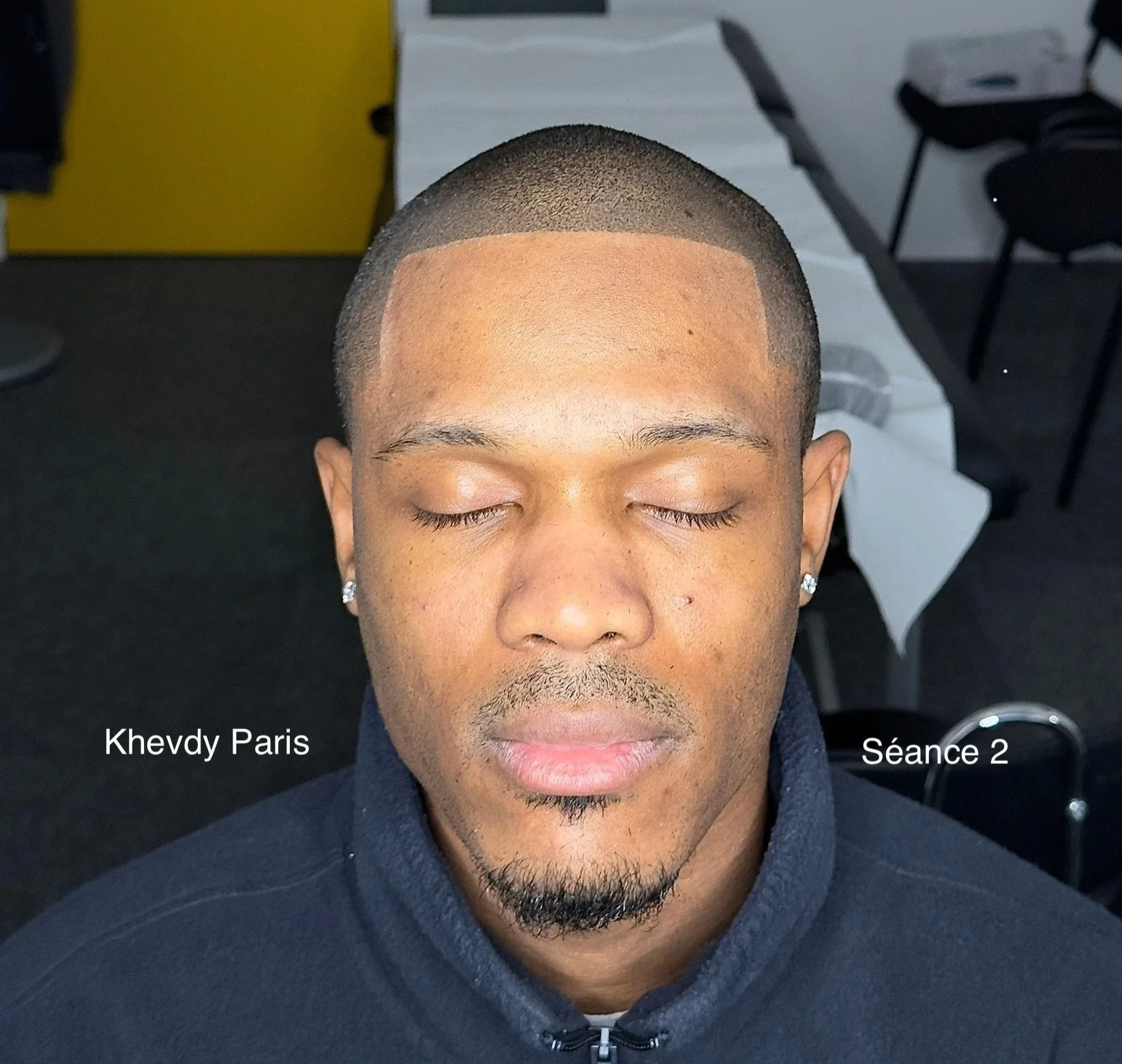  micropigmentation-capillaire-ligne-frontale-homme.jpg micropigmentation-capillaire-reconstruction-frontale.jpg