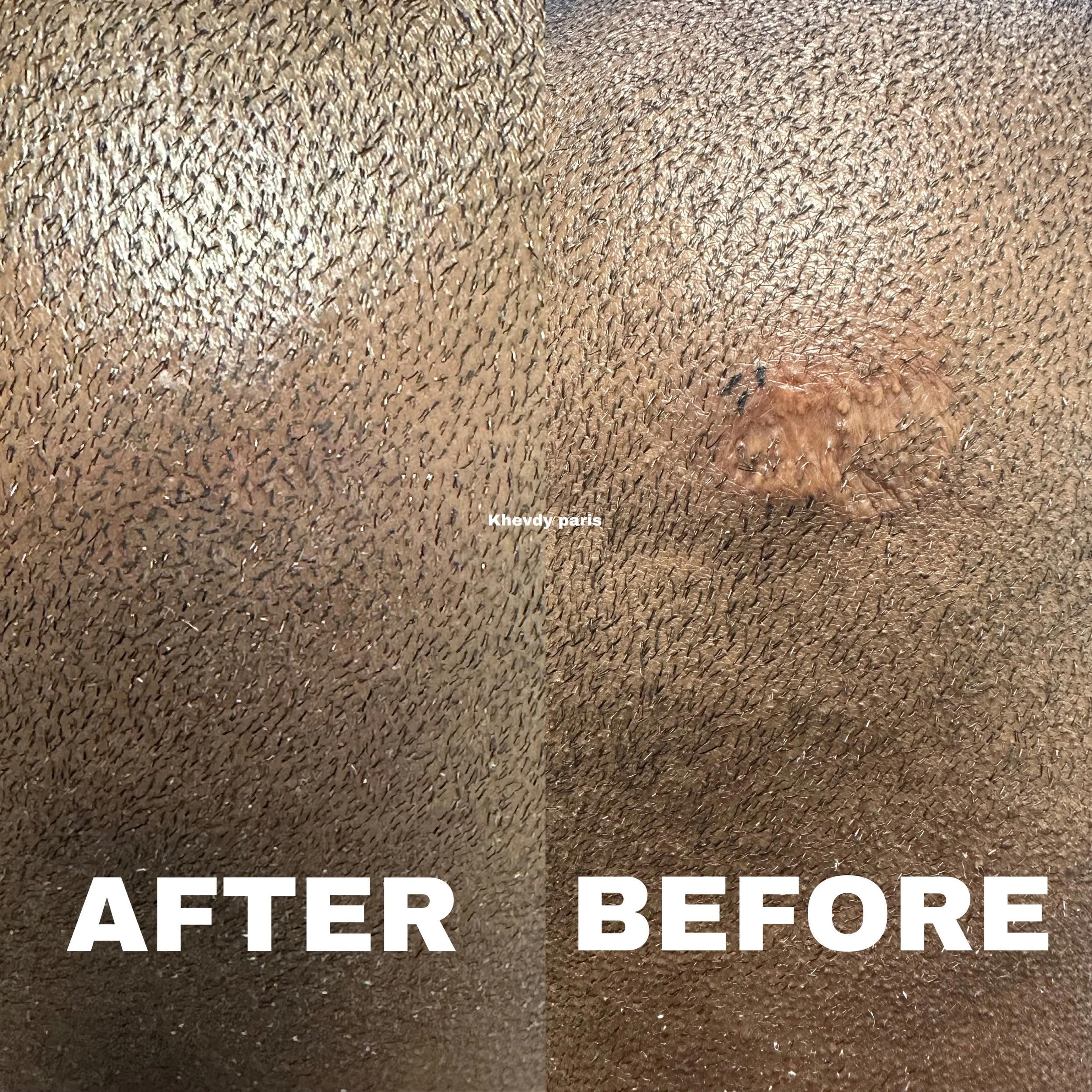 Cicatrices FUE/FUT . Camouflage de cicatrices précis et naturel.Grâce à un travail minutieux, nous adaptons chaque intervention à votre situation capillaire pour un rendu discret, efficace et parfaitement naturel.