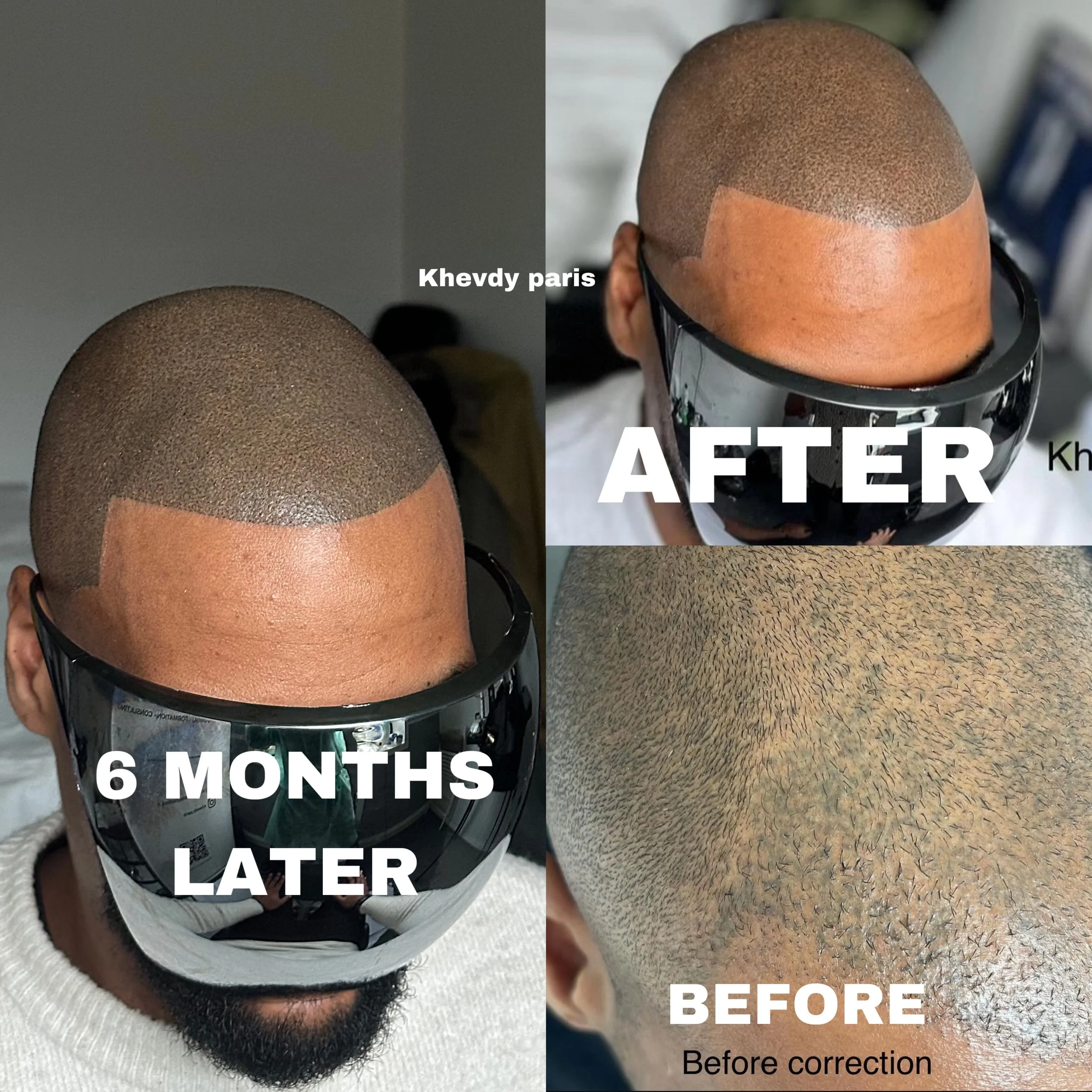 Transformation capillaire avec une coupe courte, montrant le avant, après 6 mois, et le résultat final après correction