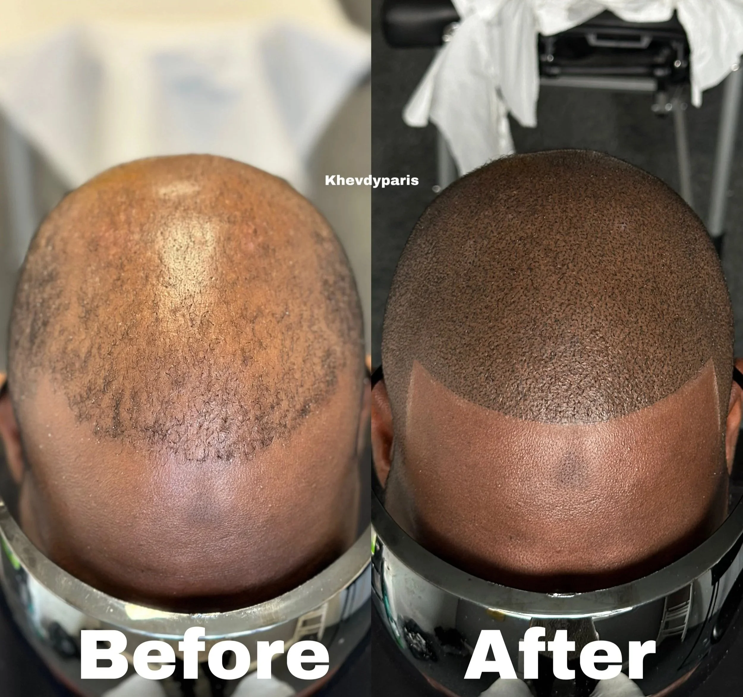 Densité et contours : Nous ajoutons de la densité sur les zones naturellement clairsemées ou en complément d’une greffe capillaire car en moyenne il y a 30% de perte de greffons. Teinte, intensité et le look esthétique du pigment sont ajustées avec p