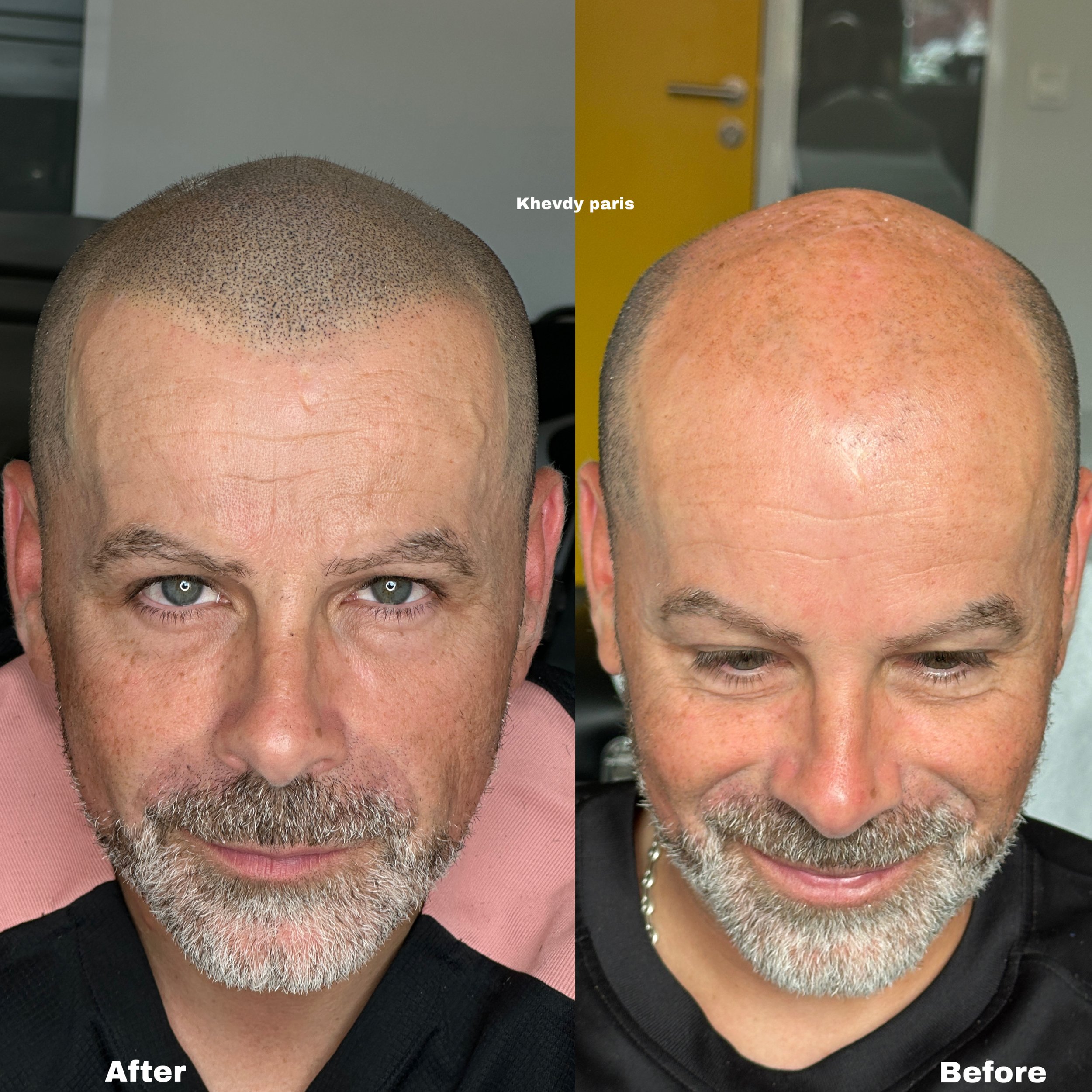 Effet rasé style européen. Retrouvez un look homogène et naturel, efficace contre la calvitie à tous les stades. Quel que soit le niveau d’évolution, notre approche sur mesure garantit un résultat optimal, avec un suivi personnalisé sur plusieurs moi