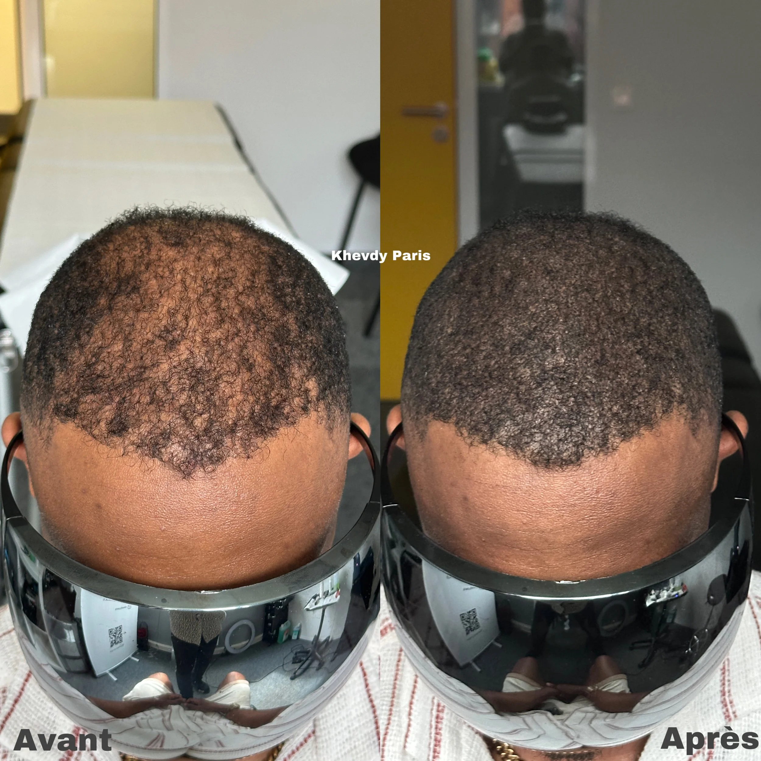 Résultat avant / après micropigmentation capillaire