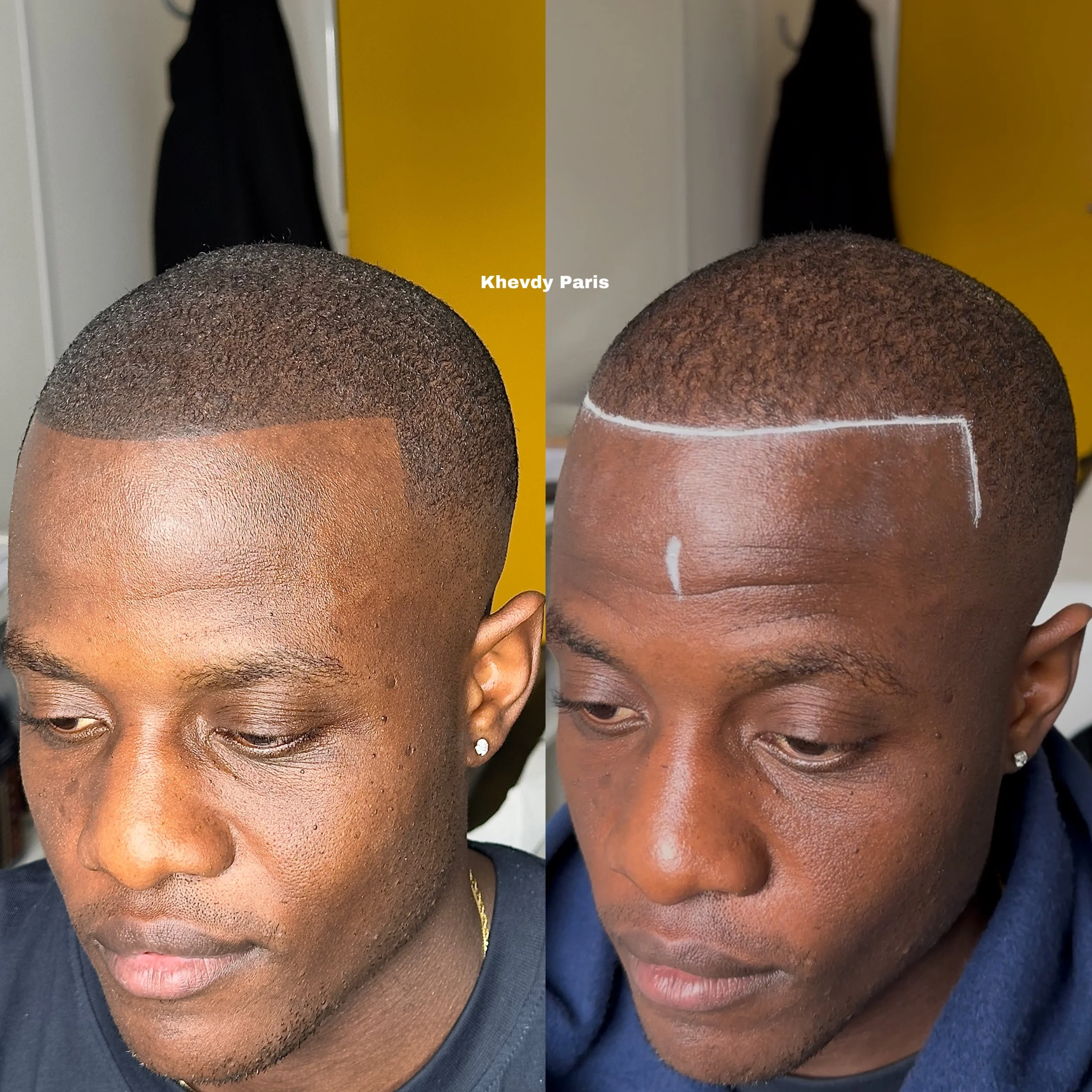 micropigmentation-capillaire-calvitie-homme-paris.jpg micropigmentation-capillaire-calvitie-cuir-chevelu-france.jpg