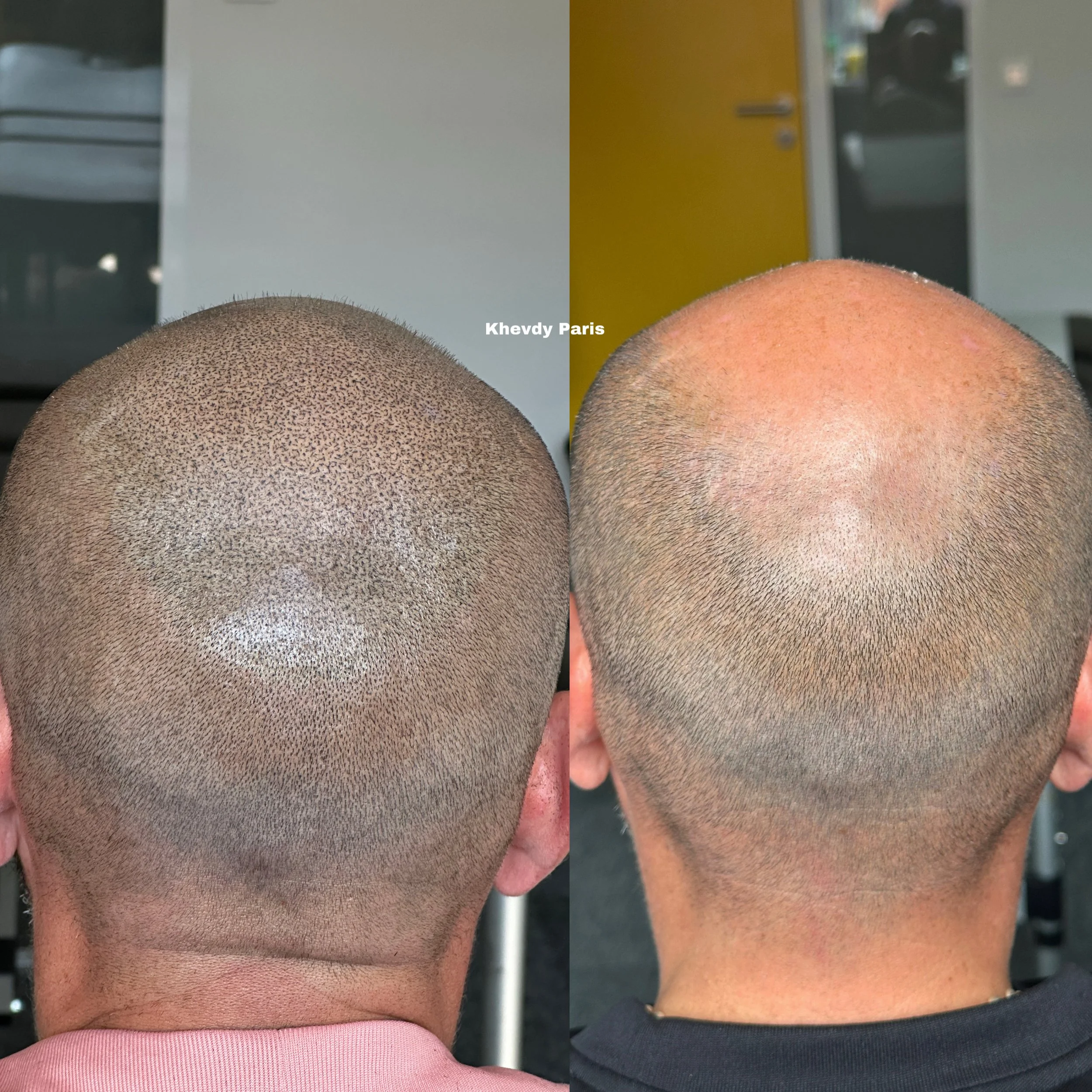 Comparaison de deux photos montrant le sommet de la tête d'un homme, une avant et une après une séance de rasage ou traitement capillaire, avec la peau visible et une petite zone claire sur la première photo.