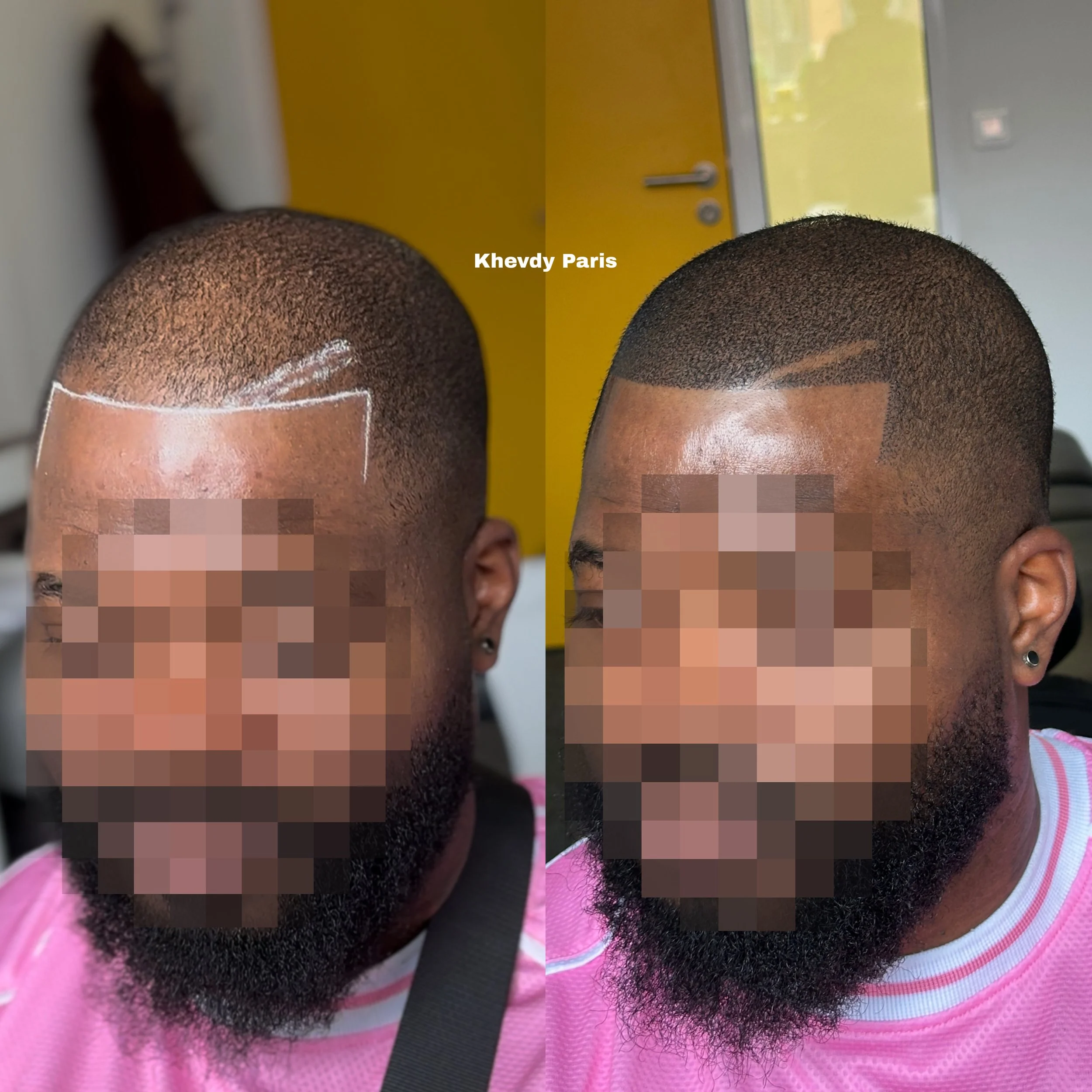 Deux photos côte à côte d'un homme avec une barbe et une coiffure à peau rasée. La photo de gauche montre la tête de l'homme avec des lignes blanches tracées sur le cuir chevelu, probablement pour planifier une coupe. La photo de droite montre la mêm