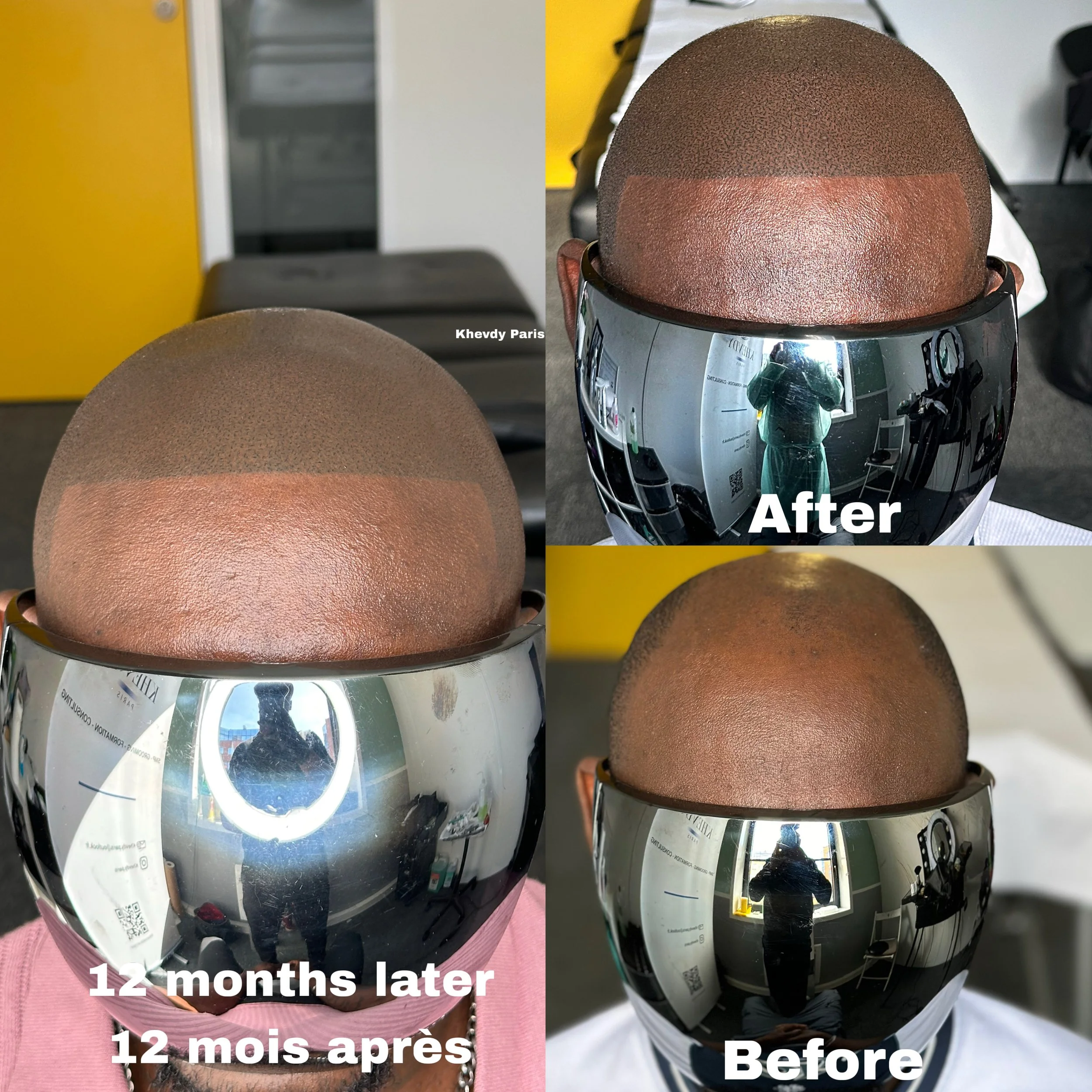 Comparaison de la croissance de la tête d'une personne avec une coupe de cheveux en quatre images : avant, après, 12 mois plus tard, avec la même coiffure. La personne porte un casque de moto réfléchissant.