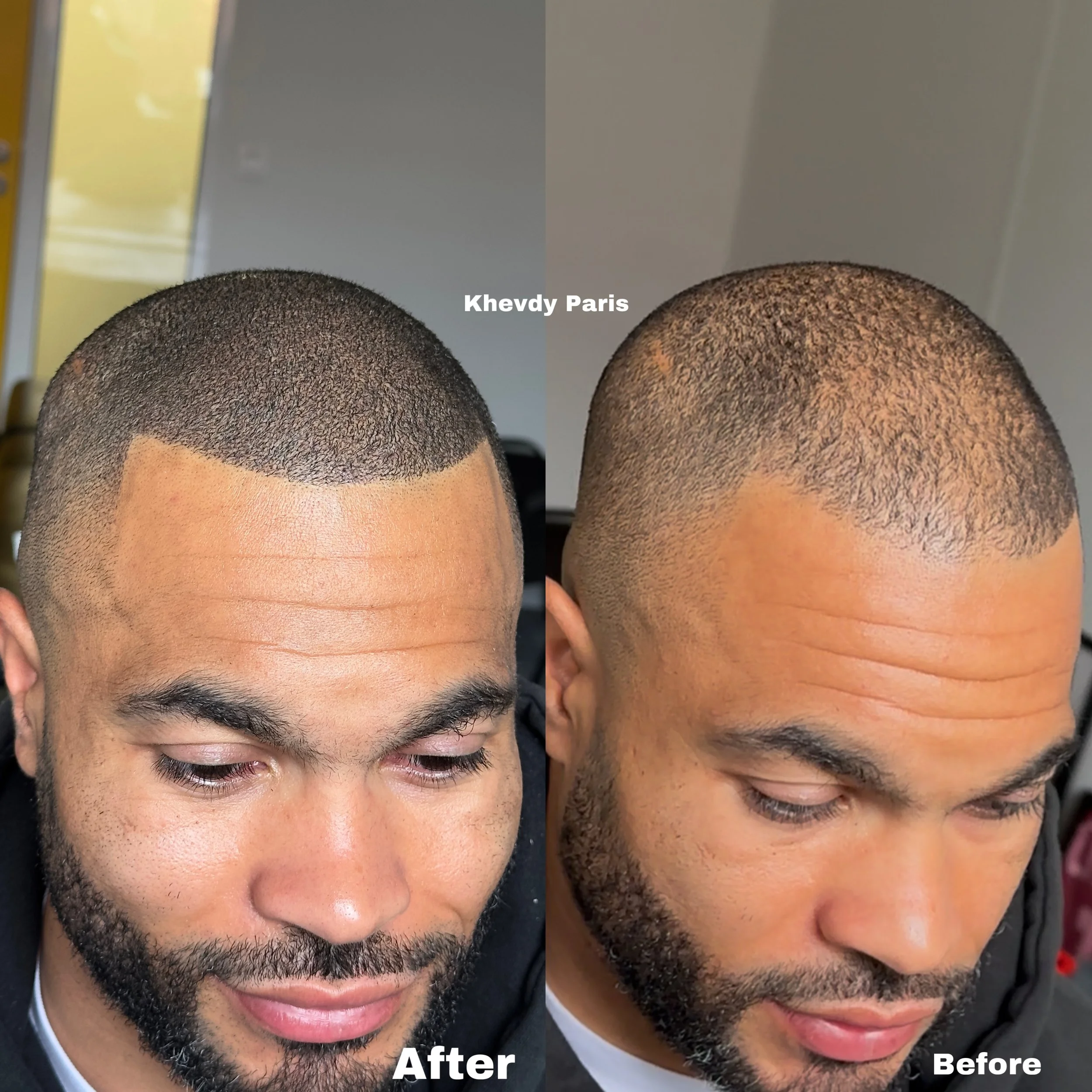 SMP densité pur notre client venu de Lille. Densité naturelle avec contours sur mesure

Comparaison avant et après d'une coupe de cheveux homme, style courte avec ligne nette. Sur la gauche, coupe récemment réalisée, sur la droite, coupe précédente p