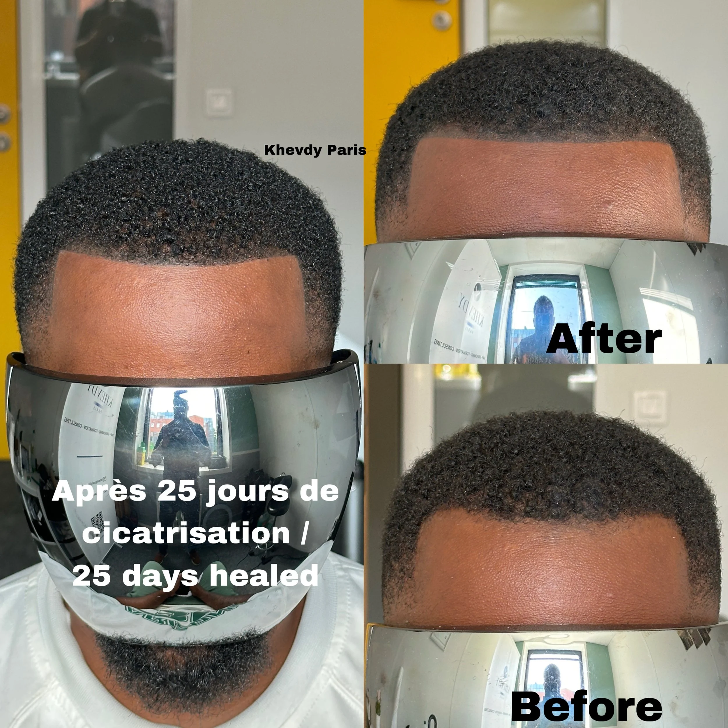 Avant et après une greffe de cheveux, montrant la repousse après 25 jours de cicatrisation, avec deux images de la tête du patient avant et après le traitement.