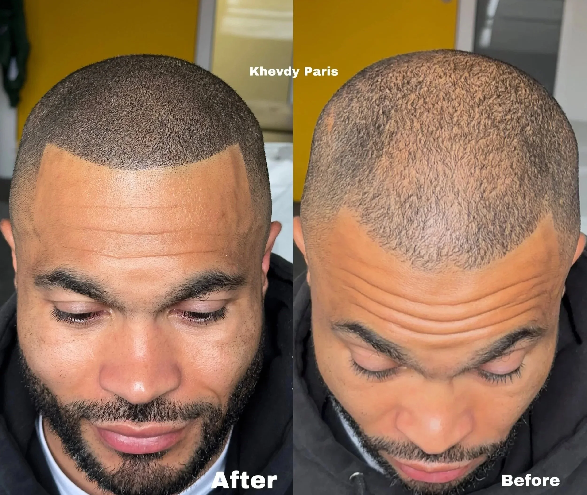 Densité : Nous ajoutons de la densité sur les zones naturellement clairsemées ou en complément d’une greffe capillaire car en moyenne il y a 30% de perte de greffons. Teinte, intensité et le look esthétique du pigment sont ajustées avec précision pou