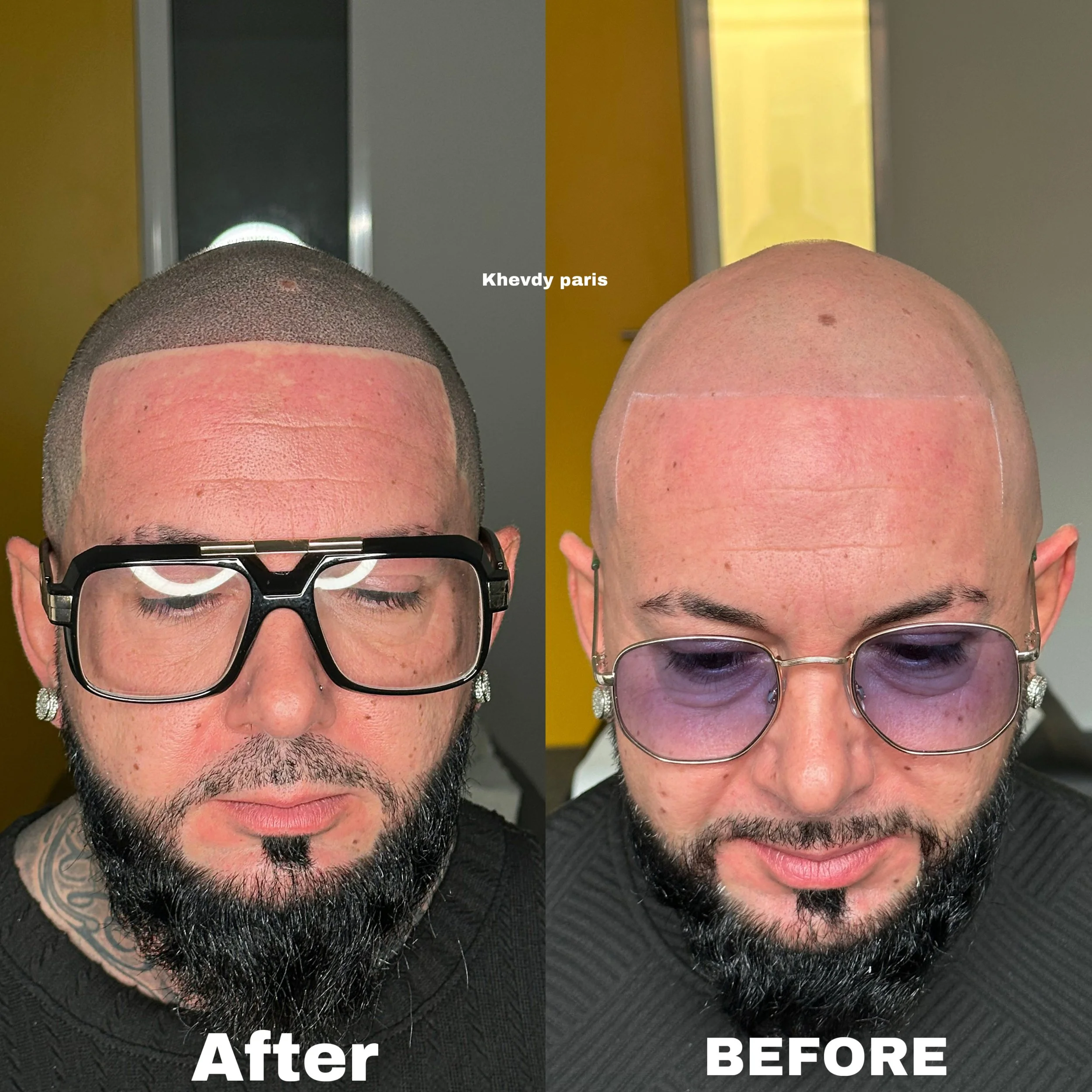 Effet rasé style américain.  Retrouvez un look homogène et naturel, efficace contre la calvitie à tous les stades. Quel que soit le niveau d’évolution, notre approche sur mesure garantit un résultat optimal, avec un suivi personnalisé sur plusieurs m