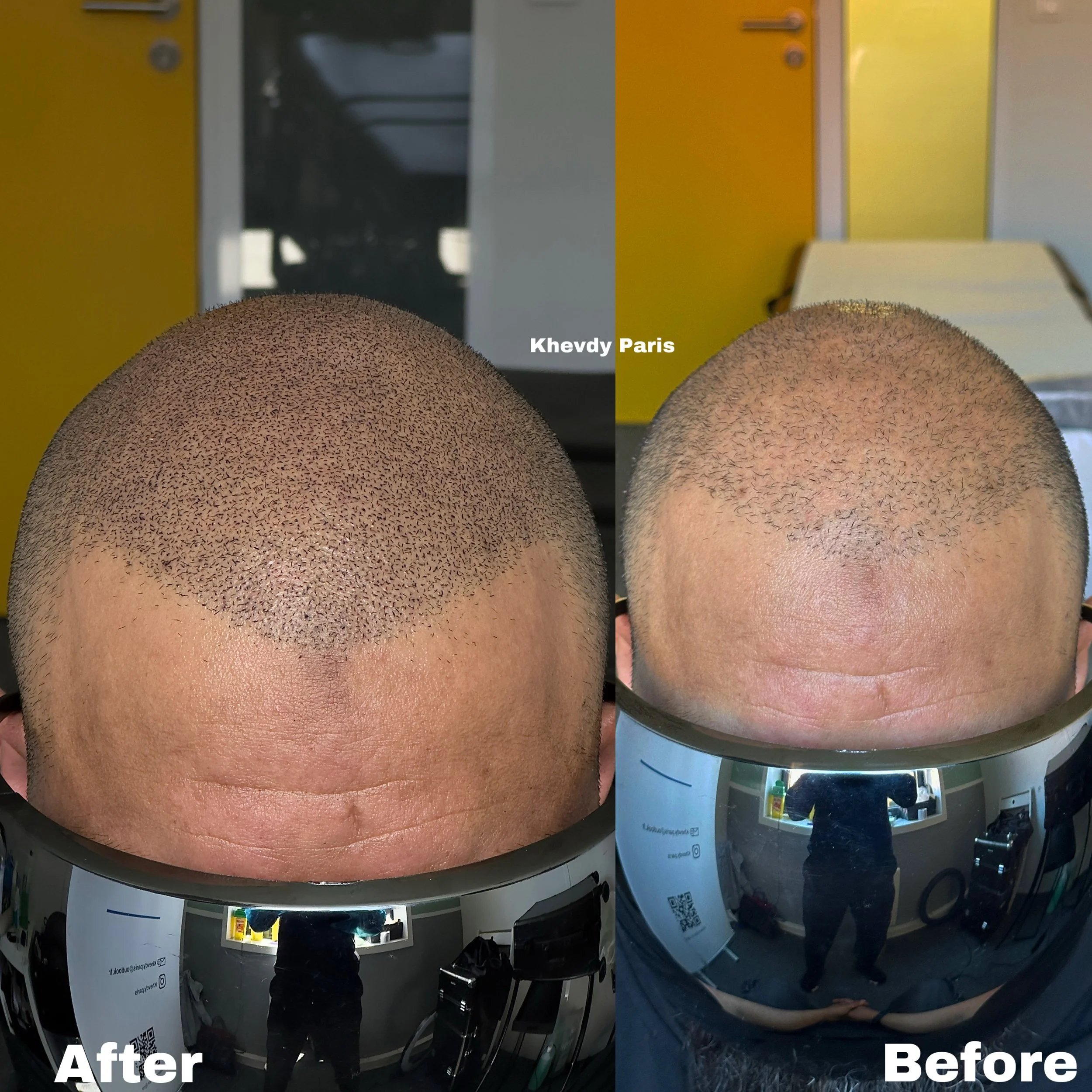 Résultat avant / après micropigmentation capillaire